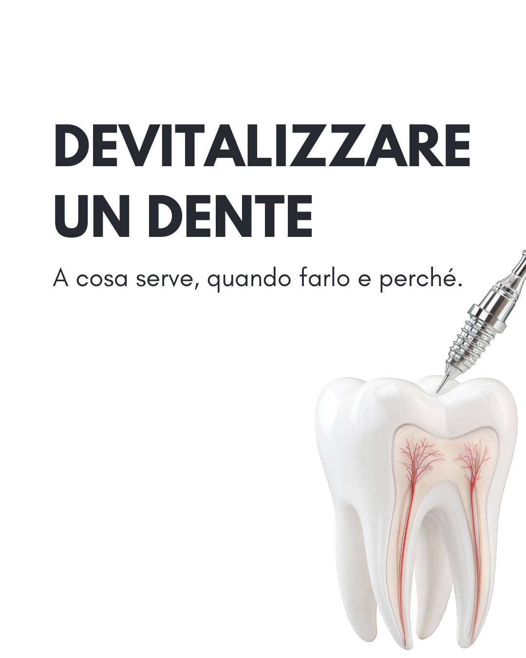 Non è “una tortura medievale”, è il modo più sicuro per salvare un dente quando la polpa è infiammata o infetta.
Una carie non curata o un evento traumatico possono creare infezioni all'interno del dente, dove passano nervi e vasi sanguigni. Il campanello d'allarme può essere un dolore intenso ma in alcuni casi può essere anche asintomatico. Per questo è importante effettuare controlli regolari.
In pratica: si isola il dente con una diga in gomma, per evitare ogni tipo di contaminazione con il resto della bocca, si pulisce e disinfettano i canali e la camera pulpare, si sigillano e poi si ricostruisce e si incapsula il dente per proteggerlo e perché torni a fare il suo lavoro.
Fa male?
Con l’anestesia no: potresti avvertire solo un fastidio nei giorni successivi, gestibile con le indicazioni del medico. È molto più rischioso (e doloroso) rimandare.
Quante sedute?
Dipende da quanti canali e dallo stato dell’infezione: alcuni denti si risolvono in una seduta, altri richiedono passaggi aggiuntivi.
Dopo, cosa succede?
Il dente è più fragile: per evitare che si fratturi e si debba estrarre, spesso serve un intarsio o una corona per proteggerlo nel tempo.
Piccole attenzioni = grande durata.
La cura migliore è quella che capisci.
Seguici per altri contenuti.