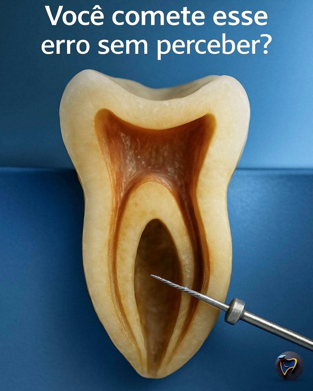 O erro mais comum na instrumentação não está na lima — está na preparação.
O glide path é a “pista segura” para o movimento rotatório: ele reduz torque, evita fraturas e mantém a anatomia original.
👉 Faça o teste: compare um canal instrumentado com e sem glide path sob microscópio — a diferença é clara.
💡 Dica clínica: combine limas manuais 10 e 15 com irrigação ativa antes da mecanização.
Automatizado poderia ser R-Pilot ou ProGlider
💬 Comente: você ainda pula essa etapa?
🔖 Salve e compartilhe com seu grupo de estudos.
#endodontia #odontologia #endodontics #dentista #dentistry #brasil #endolovers #odonto #endodontiamicroscopica #tratamentodecanal #endo #dentistas #saopaulo #sp #endodoncia #endodontic #dentist #endodontiabrasil #endodontiauberlândia #endodontiaportovelho #aorp74anos #dicasendodonticas #unaerp #ufu #unitri #faculdadepitágoras #uniube #uspribeirao #faculdadeestácio #uspribeirao
@abo.rondonia @hdensinosoficial @aorp1946 @apcdararaquara
@thaischriscunha @pascoalinodoc @martinmeirelles @daniedison