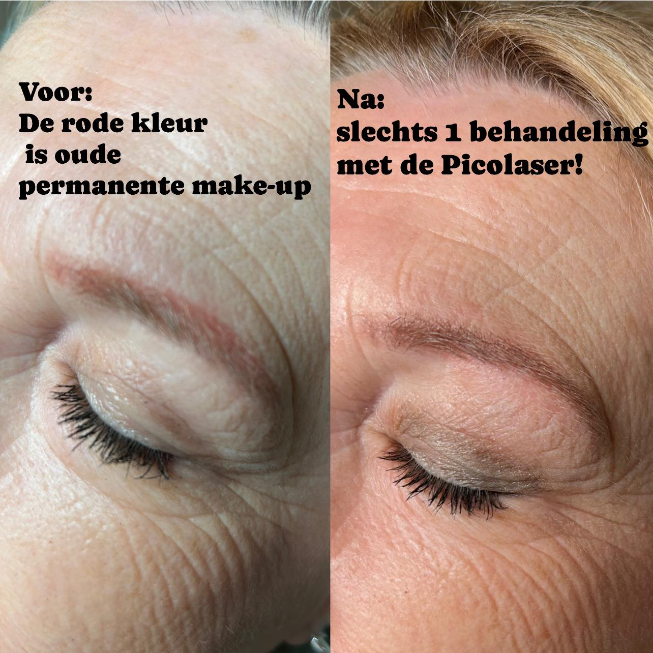Permanente make-up kan lelijk verkleuren met de jaren.
Tegenwoordig zijn ze pigmenten veel beter, maar we zien vaak “oude” permanente make-up wat erg rood is geworden.
Een behandeling met de Picolaser is de oplossing!
Boek online een gratis intakegesprek in!
www.schoonheidssalonwilmameins.nl
#schoonheidssalonwilmameins #centrumveendam #picolasertreatment #verwijderenvanpermanentemakeup #liefzijnvoorjezelf