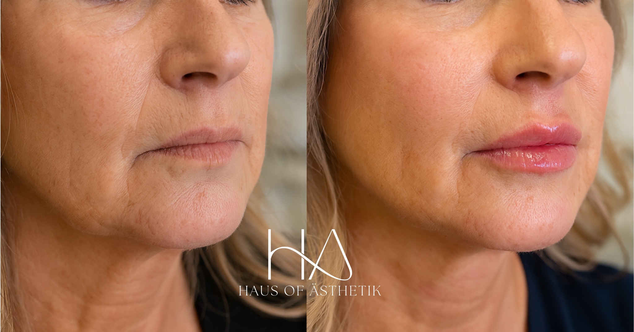 ✨ Were back ✨
We’ve been a little quiet on here recently, not because we’ve disappeared, but because we’ve been busy behind the scenes with our lovely patients and welcoming some exciting new additions to the clinic (more on that very soon…).
This beautiful lady in her 50s came to us feeling that her lips had lost volume and definition over the years. She didn’t want anything exaggerated; she just wanted a return to the soft, hydrated look she used to feel confident with.
Treatment: Mesoestetic® Mesolips
Why this product?
Mesolips combines hyaluronic acid with succinic acid, stimulating collagen while hydrating and volumising, making it ideal for restoring shape, smoothness, and glow to mature lips.
👄 Result:
Soft. Restored. Natural.
A subtle return of volume and gentle contouring, without changing the character of her smile.
We love delivering results that help you feel more like you again, just rested, radiant, and a little more confident ✨
📍 Bakewell, Derbyshire
📞 01629 385318
📩 DM to enquire or book
🖥 www.HausOfAsthetik.co.uk
#LipRestoration #Mesolips #HyaluronicAcid #SuccinicAcid #NaturalLips #MatureSkinAesthetics #ConfidenceAtEveryAge #HausOfAsthetik #LipVolume #HealthyAging #BakewellClinic #AdvancedInjectables #SaveFaceAccredited #CQCClinic