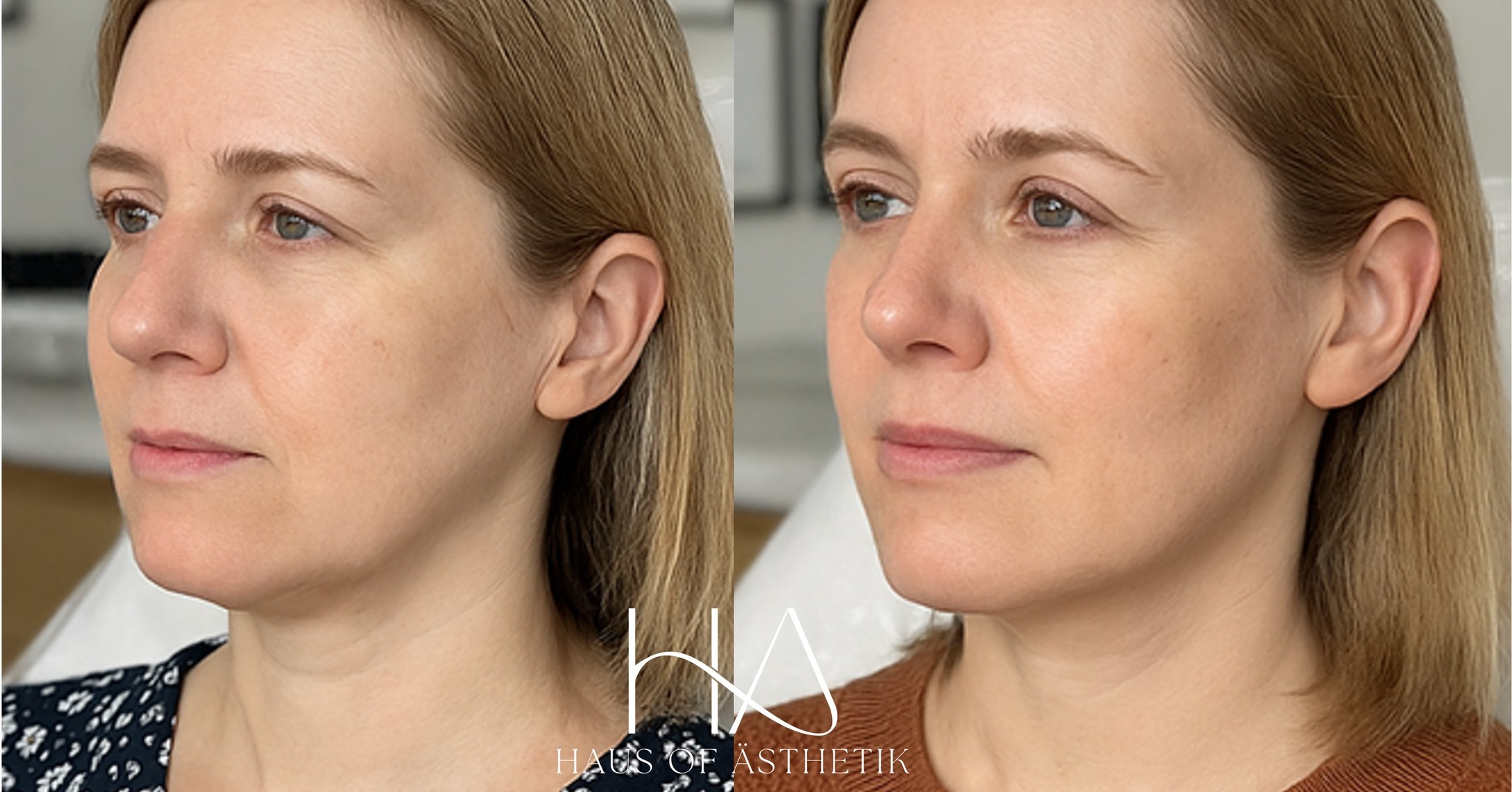 ✨ Profhilo® Skin Remodel – Subtle, Lasting Radiance ✨
This lovely client came to Haus of Ästhetik seeking a treatment that would improve her skin quality without changing her facial shape or expression. After a full consultation and skin assessment, we began her Profhilo® journey, a regenerative injectable treatment that stimulates collagen, elastin, and hydration from within.
Over a 12-week plan, she received three full treatments of Profhilo®, spaced at clinically appropriate intervals to allow for gradual bio-remodelling. This protocol goes beyond hydration; it supports the skin’s architecture, subtly improving tone, elasticity, and firmness.
What we love about Profhilo is that it doesn’t fill, freeze, or inflate; instead, it softens fine lines, enhances skin luminosity, and restores that healthy, supple bounce that many of us begin to lose over time.
📸 Left: Before treatment | Right: Final result, 3 weeks after her third session
Note the softened texture, more even tone, and beautifully natural finish, no makeup, no filter.
🖥 www.HausOfAsthetik.co.uk
📍 4 Portland Square, Bakewell
📞 01629 385318
📩 DM us to enquire about your personalised skin programme
📸 Patient consented to the use of clinical photographs for promotional purposes.
#Profhilo #SkinRemodelling #NaturalResults #BioRemodelling #SkinBooster #HausOfAsthetik #CQCRegistered #SaveFaceAccredited #AdvancedInjectables #BakewellClinic #SubtleEnhancement #CollagenBoost