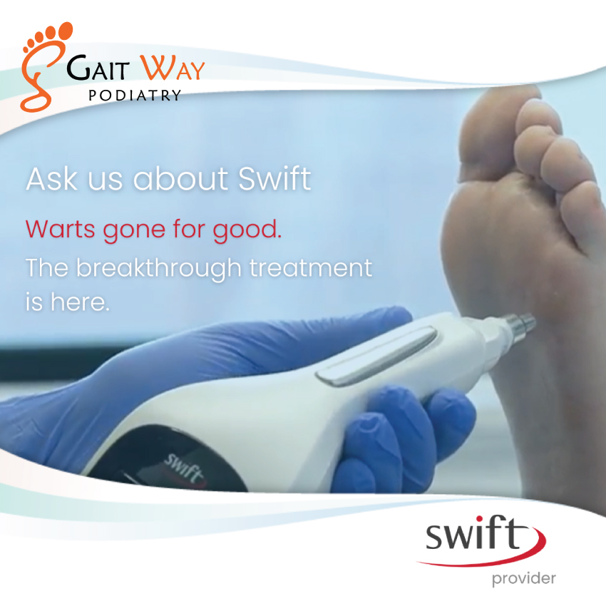 Warts on the feet (also known as plantar warts or verrucae) can be stubborn, painful, and frustrating to treat. Gaitway Podiatry welcomes SWIFT!
How is SWIFT different?
Swift is a state-of-the-art technology specifically designed for the treatment of plantar warts, which uses microwave energy delivered through a precise handpiece, targeting the wart tissue at depth without breaking the skin. This means:
* No need for dressings โ you can continue daily activities immediately after treatment.
* Minimal discomfort afterwards โ thereโs no open wound, so recovery is quick.
* Immune activation โ the treatment encourages the body to clear not only the treated wart but potentially other warts present on the feet.
FIND OUT MORE! (๐๐) ๐๐๐๐ ๐๐๐๐
https://www.gaitway.com.au/post/wart-treatment-using-swift