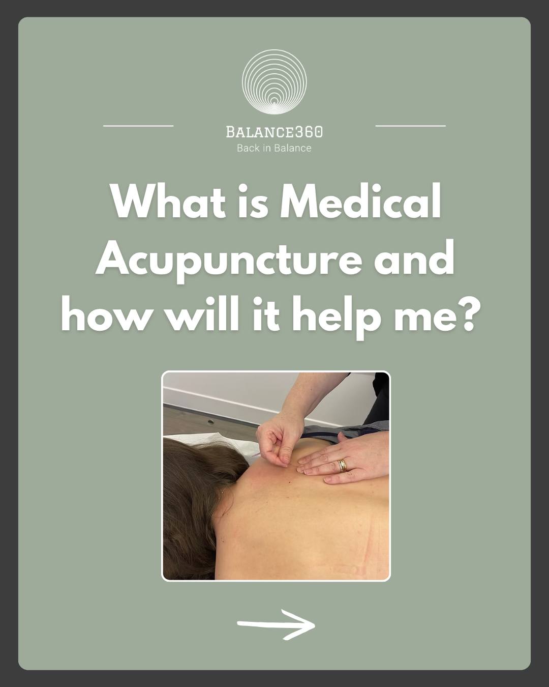 ✨ MEDICAL ACUPUNCTURE EXPLAINED ✨
Swipe to learn how medical acupuncture helps release tight muscles, reduce pain and support your body’s natural healing response 🌿
Ready to feel the difference? 💚 Get your session booked in today by visiting our website - link in bio 🔗
#Balance360 #medicalacupuncture #andoverwellness #painrelief #musclerecovery #holistichealth #hampshirebusiness #andover