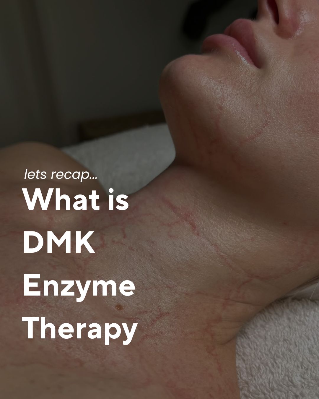 A little DMK recap because this treatment continues to impress me every single time ✨
Enzyme Therapy works deeper than the surface it’s all about restoring true skin function. By stimulating cellular activity, boosting oxygenation, and encouraging healthy circulation, the skin is literally “woken up” from within.
That signature Plasmatic Effect you see after treatment isn’t just a visual moment it’s the evidence of fresh, oxygenated blood feeding the skin and supporting real change. DMK remains unmatched in how it rebuilds, repairs, and revitalises the skin on a biological level.