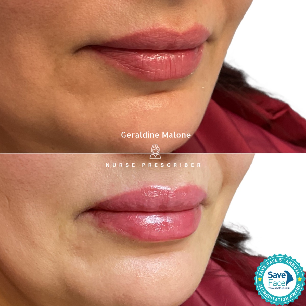 āØ0.5ml Lip Enhancement Treatment
Hydration and subtle volume, whilst maintaining natural shape and proportion
- NO edited images
- Treatment price: 0.5ml/Ā£145, 1ml/Ā£225
- Recovery time: 24/48hrs
- Results lasting 6-12 months
All treatments carried out by Nurse Prescriber Geraldine Malone in a Save Face Registered Clinic
Book Now via the link below:
https://www.geraldinemalone.co.uk/book-appointment
Contact Us:
āļø 024 7792 1812
š§ geraldinemaloneaesthetics@outlook.com