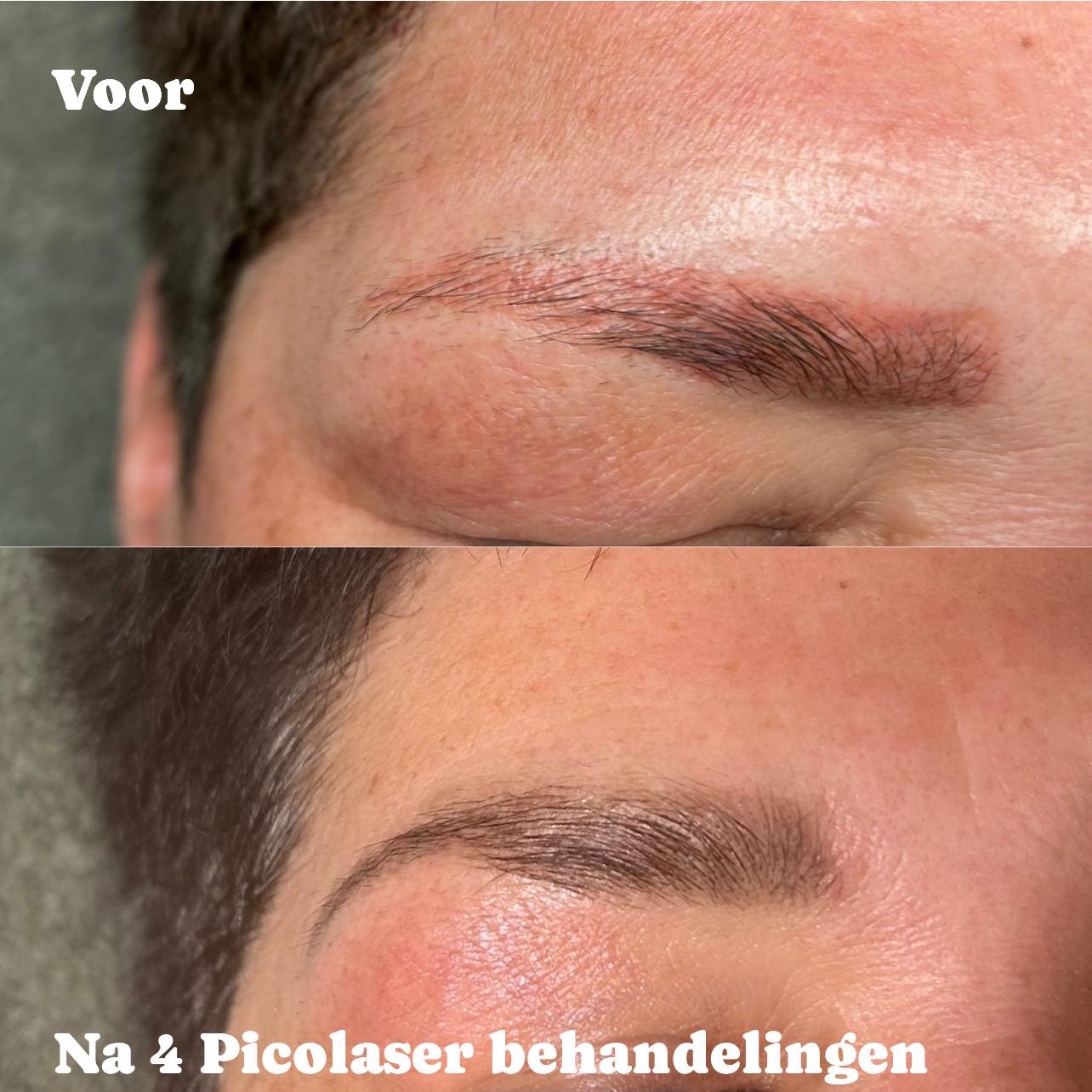 Heb je spijt van je permanente make-up of is het in de loop van tijd lelijk verkleurd?
Maak een afspraak voor een gratis intake en we adviseren je graag hoe we je kunnen helpen!
www.schoonheidssalonwilmameins.nl
#schoonheidssalonwilmameins #centrumveendam #verwijderentatoeage #verwijderenpermanentemakeup #langmairpicolaser #liefzijnvoorjezelf