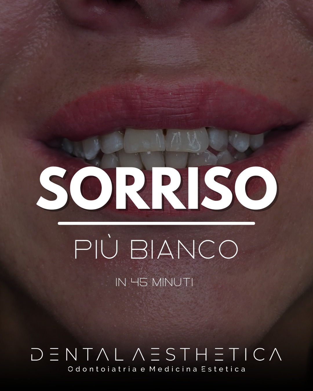 Denti più bianchi in pochi minuti?
Hai mai pensato di voler arrivare a una data, un appuntamento o un evento con i denti più illuminati? Un sorriso bianco e splendente aumenta la nostra sicurezza quando ci relazioniamo con gli altri e in alcune occasioni questo è quasi imprescindibile.
Vieni a scoprire lo sbiancamento in poltrona, per denti visibilmente più bianchi in meno di un'ora.
Dental Aesthetica
📍viale della Grande Muraglia 256 - zona EUR-Torrino
📱378 55 47 069
#dentista #dentibianchissimi