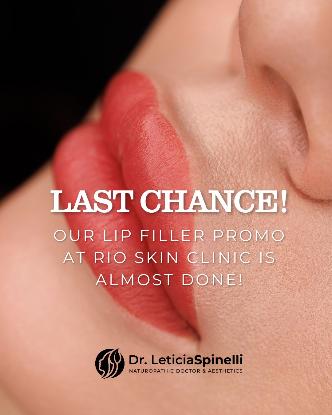 💋 Last Chance! Our lip filler promo at Rio Skin Clinic is almost done! 💋
Enhance your smile before the offer ends:
✨ Full Lip Filler – $599
✨ Mini Lip Filler – $399
Don’t miss out! Book now with Dr. Leticia Spinelli and get the luscious lips you’ve been dreaming of.
#LastChance #LipFiller #DrLeticiaSpinelli #LipGoals #PlumpLips #LipFillerSpecial #BeautyOffer #GlowUp
