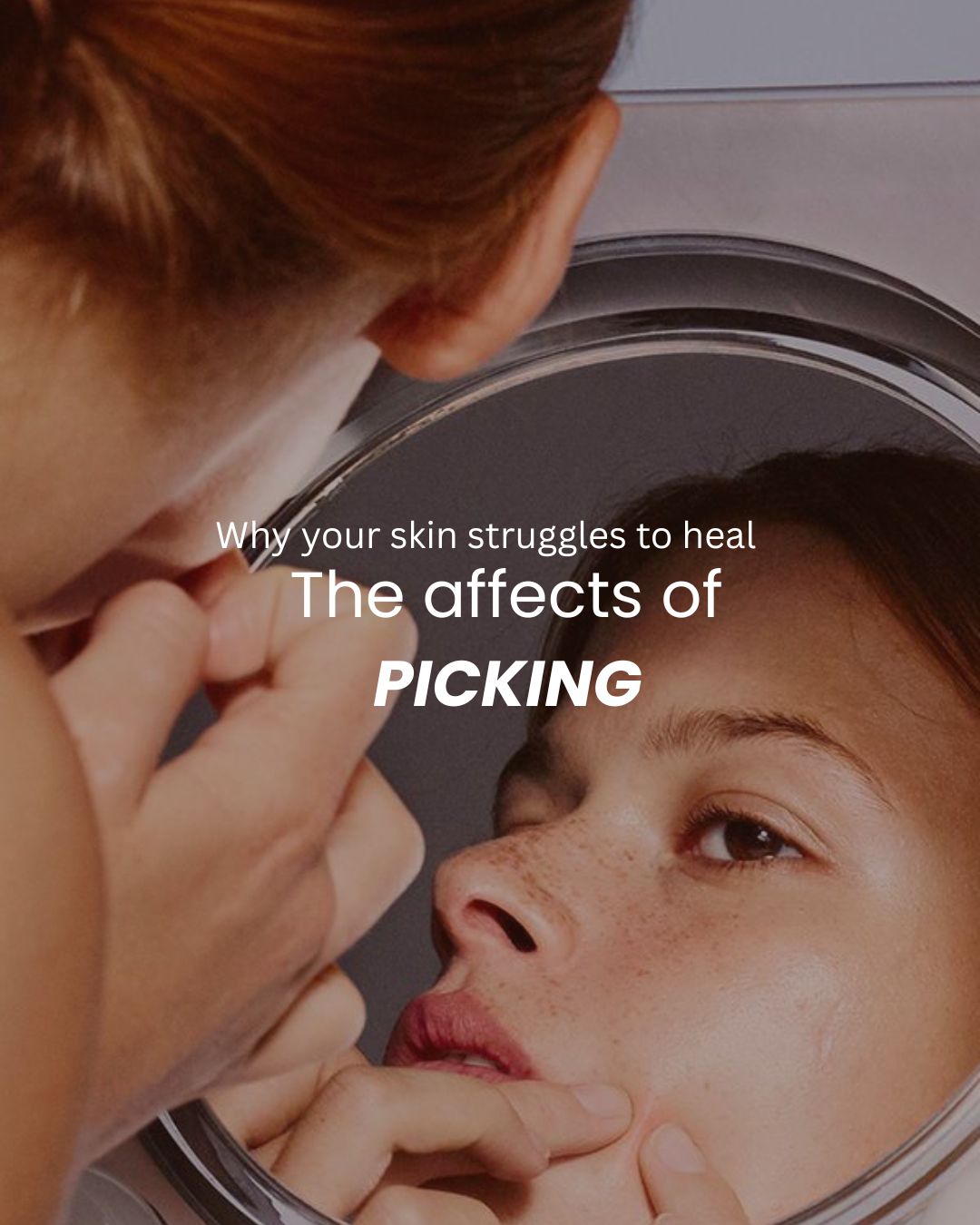 Skin picking is something so many people struggle with often quietly. It’s not “lack of willpower,” and it’s not something you can just stop.
It’s a stress response, a comfort habit, a moment of escape… and sometimes it becomes a cycle that’s hard to break.
Chronic picking doesn’t just affect the skin’s surface. It impacts your emotional wellbeing, your confidence, and the way your skin functions long-term. The good news? With the right support, healing is absolutely possible.
This is where DMK Skin Revision is so powerful. DMK works with your skin’s own biology to rebuild the barrier, reduce inflammation, support wound healing, and improve scarring and pigmentation over time. When we restore function, we reduce the triggers that make you want to pick in the first place.
If you’re ready to rebuild your skin and feel more confident in it again, I’m here.
Send me a message or book a consult to start your DMK skin revision journey. 💛