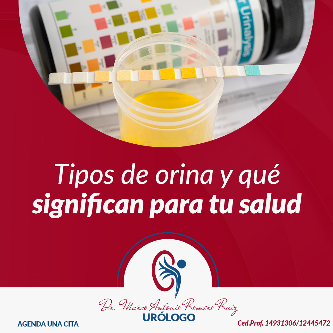 🚽🔍Tu orina habla… y mucho.
🤔¿Cuándo acudir al urólogo?
✔️ Si el cambio no desaparece en 24–48 horas
✔️ Si duele, arde o hay fiebre
✔️ Si hay sangre visible
✔️ Si la espuma o turbidez es persistente
¿Ya checaste su color?
📅Agenda tu chequeo
📱📞442 883 1992 | 331 973 9480
#SaludUrinaria #Urología #TiposDeOrina
