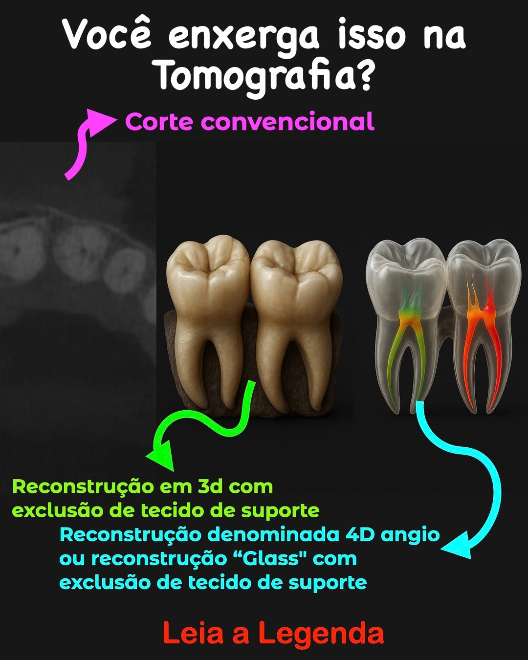 🦷 Você enxerga isso na Tomografia?
A diferença entre ver e compreender a anatomia interna do dente pode mudar completamente o desfecho clínico.
Na imagem acima, você observa três níveis de percepção:
1️⃣ TC axial bruta: Uma fatia de 0,20mm.
2️⃣ Reconstrução 3D da morfologia: revela volumes reais e curvaturas. Requer software especifico.
3️⃣ Modelo transparente denominada pela primeira vez pela PIquer em 1999, como 4d Angio, aonde a estrutura é montada em 3D porem transparente e hoje associada a I.A. cria o possível mapa de risco: onde a instrumentação pode se tornar crítica — exatamente onde muitos casos falham. Requer software especifico.
👉 A Endodontia moderna exige profundidade, não adivinhação.
A maior parte das iatrogenias nasce onde o clínico não percebe o risco anatômico.
Se você deseja evoluir sua leitura de imagem, dominar canais complexos e reduzir erros silenciosos, precisa desenvolver essa visão tridimensional.
📌 A pergunta é:
Você está tratando o dente real… ou apenas a imagem plana?
🔵 Salve este post para revisar antes do seu próximo caso.
🔵 Comente: qual das três etapas mais te surpreendeu?
🔵 Compartilhe com um colega que precisa ver isso.
#endodontia #odontologia #endodontics #dentista #dentistry #brasil #endolovers #odonto #endodontiamicroscopica #tratamentodecanal #endo #dentistas #saopaulo #sp #endodoncia #endodontic #dentist #endodontiabrasil #endodontiauberlândia #endodontiaportovelho #aorp74anos #dicasendodonticas #unaerp #ufu #unitri #faculdadepitágoras #uniube #uspribeirao #faculdadeestácio #uspribeirao
@abo.rondonia @hdensinosoficial l @aorp1946 @apcdararaquara
@thaischriscunha @pascoalinodoc @martinmeirelles @daniedison