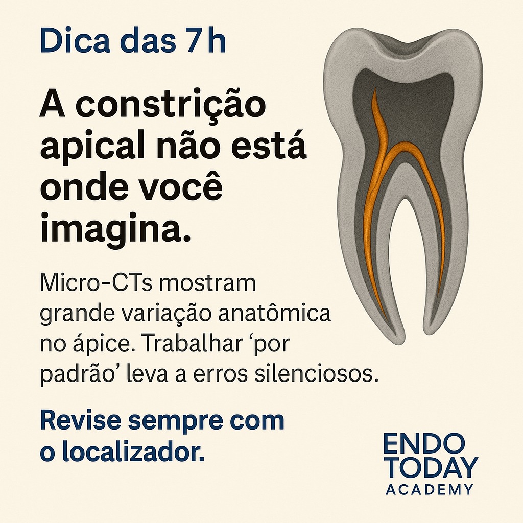 A constrição apical não é fixa — ela varia entre indivíduos, dentes e raízes.
Micro-CTs mostram que trabalhar “por padrão” aumenta o risco de ultrapassagens, transporte apical e falhas silenciosas.
A endodontia moderna exige precisão anatômica, não suposições.
🔍 Conclusão clínica: revise sempre o comprimento com o localizador foraminal.
Essa é a diferença entre segurança e iatrogenia.
🔗 Aprofunde este tema nos cursos da EndoToday Academy.
#endodontia #odontologia #endodontics #dentista #dentistry #brasil #endolovers #odonto #endodontiamicroscopica #tratamentodecanal #endo #dentistas #saopaulo #sp #endodoncia #endodontic #dentist #endodontiabrasil #endodontiauberlândia #endodontiaportovelho #aorp74anos #dicasendodonticas #unaerp #ufu #unitri #faculdadepitágoras #uniube #uspribeirao #faculdadeestácio #uspribeirao