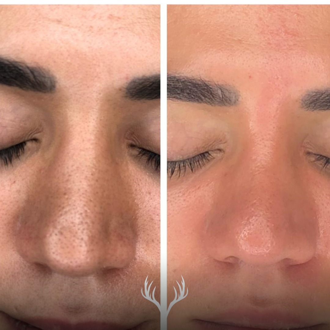 Poren „wegzaubern“ kann man nicht – aber man kann sie sichtbar verfeinern, wenn man die Hautstruktur wirklich verbessert. ✨
Und genau da ist Retinol (richtig eingesetzt!) ein Gamechanger.
Warum Retinol bei Poren so gut funktioniert:
🧬 es unterstützt die Zellerneuerung
🪶 glättet Textur, wirkt gegen Verhornungen
🧼 Poren wirken sauberer und dadurch optisch feiner
(plus: oft auch weniger Unreinheiten & ebenmäßigerer Teint)
So kombinieren wir das bei uns sinnvoll:
💦 HydraFacial + passender Booster im Studio
HydraFacial ist die perfekte Basis, weil wir die Haut porentief reinigen, Ablagerungen lösen und dann mit einem passenden Booster gezielt an Textur/Porenbild arbeiten können. Das macht Retinol zu Hause meistens besser verträglich, weil die Haut insgesamt „ordentlicher“ wird.
🏠 Heimpflege mit Circadia: die Retinol-Reise gemeinsam starten
Retinol muss langsam aufgebaut werden – sonst wird’s schnell zu viel (Trockenheit, Schuppung, Rötung).
Darum gehen wir Schritt für Schritt vor und passen an, je nachdem wie deine Haut reagiert.
Alltags-Setup, das fast immer Sinn macht:
🧼 sanfte Reinigung
💧 barrierestärkende Pflege
🌿 beruhigende Begleitung (wenn die Haut sensibel wird)
☀️ täglicher SPF ist Pflicht (sonst macht Retinol keinen Sinn)
Und das Wichtigste: Du musst das nicht alleine „zusammengoogeln“. 😄
Mit uns hast du den perfekten Ansprechpartner, um Retinol sicher und sinnvoll in deine Routine zu integrieren – abgestimmt auf deine Haut und deine Ziele. 🤍
📍Beauty Bar Baden – Wiener Straße 89
📅 Termine: online buchen oder telefonisch
📞 069911307030
Skincare • Lash & Brow • Permanent Make-up • Laser
#beautybarbaden #circadia #hydrafacialbaden #retinolreise #porenverfeinerung #hauttextur #skincarebaden #badenbeiwien #professionellehautpflege #skinroutine #glowmitplan #spfistpflicht