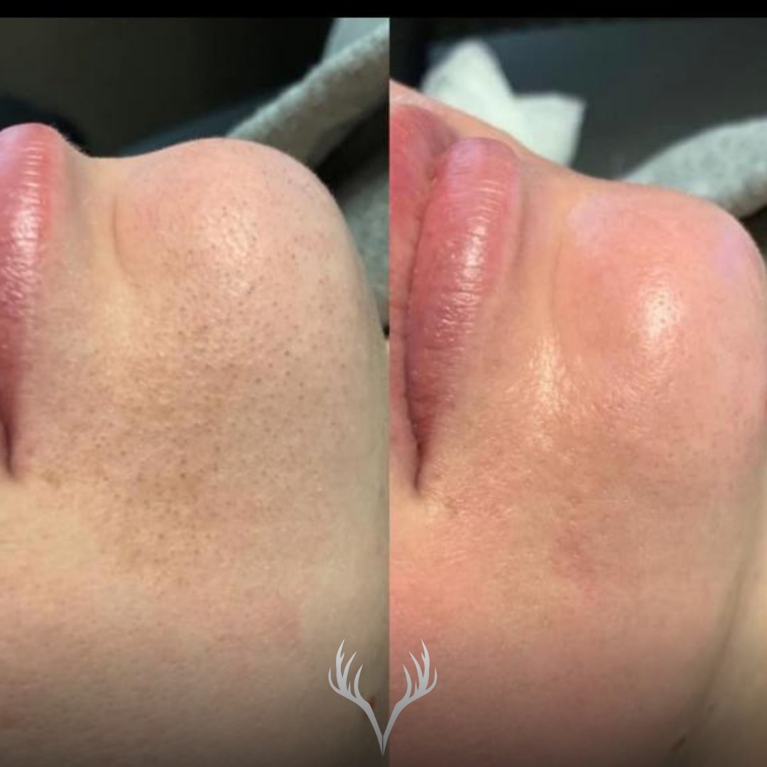 Diese kleinen „schwarzen Punkte“ am Kinn sind meistens keine „Dreckporen“, sondern offene Komedonen (Blackheads): Talg + Hornzellen sitzen in der Pore – und werden an der Oberfläche durch Sauerstoff dunkel. 🖤
Warum gerade am Kinn so oft?
👄 hormonelle Schwankungen / Stress
🤳 viel Berührung (Hand am Kinn, Handy)
😷 Reibung (Maske/Schal)
🧴 zu reichhaltige oder verstopfende Produkte / Make-up-Reste
So bekommst du sie wirklich in den Griff – Studio + Zuhause als Kombi:
Im Studio: HydraFacial als „Poren-Reset“ 💦
HydraFacial ist mega für Kinn-Unreinheiten, weil wir sanft aber gründlich reinigen, die Poren ausräumen und die Haut wieder ins Gleichgewicht bringen – ohne wildes Drücken und ohne die Barriere unnötig zu stressen.
Zuhause: BHA-Routine für die Pore 🧼
Circadia Salicylic Acid Cleanser (Salicylsäure/BHA) ist dafür super, weil BHA fettlöslich ist und genau dort arbeitet, wo das Problem sitzt: in der Pore.
👉 Tipp: Starte lieber langsam (z. B. jeden 2. Abend), 60-120 Sekunden einmassieren, dann abspülen. Wenn die Haut ruhig bleibt, kannst du steigern.
Danach: Clearing Mist als täglicher „Stabilisierer“ 🌿
Nach der Reinigung (und auch zwischendurch) hilft der Clearing Mist, das Kinn frisch und ausgeglichener zu halten – gerade bei der typischen „Kinn-Zone“, die immer wieder nachschiebt.
Wichtig, damit’s nicht wiederkommt:
🙅♀️ nicht ausdrücken (macht’s oft tiefer + entzündeter)
🧻 Kissenbezug öfter wechseln, Handy sauber halten
🧴 leichte Pflege statt „austrocknen“
☀️ SPF am Tag (vor allem, wenn du mit aktiven Wirkstoffen arbeitest)
Wenn du willst, schauen wir uns dein Kinn gezielt an und bauen dir eine Routine, die du auch wirklich durchziehen kannst. 🤍
📍Beauty Bar Baden – Wiener Straße 89
📅 Termine: online buchen oder telefonisch
📞 069911307030
Skincare • Lash & Brow • Permanent Make-up • Laser
#beautybarbaden #hydrafacial #unreinehaut #komedonen #blackheads #kinnakne #hautpflegebaden #badenbeiwien #circadia #salicylsäure #bha #skinroutine #porenrein #skincarejourney #glowmitplan