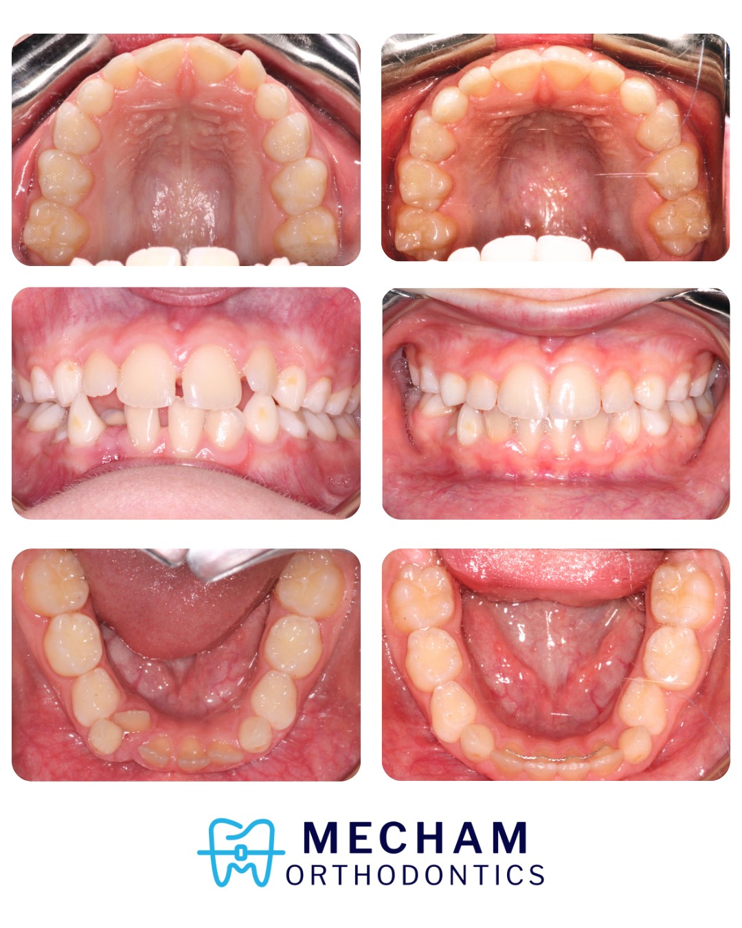 Big smiles, big changes 😁✨
This 10-year-old absolutely crushed his orthodontic journey @mechamortho ! Upper and lower braces helped correct crowding and bring a blocked out lower incisor into place🦷👏
#Phase1Braces can help guide arch development and create needed space for healthier, smoother eruption of permanent teeth, setting up for long term success.
Growing smiles, confident futures 💙✨
#InterceptiveOrthodonticTreatment
