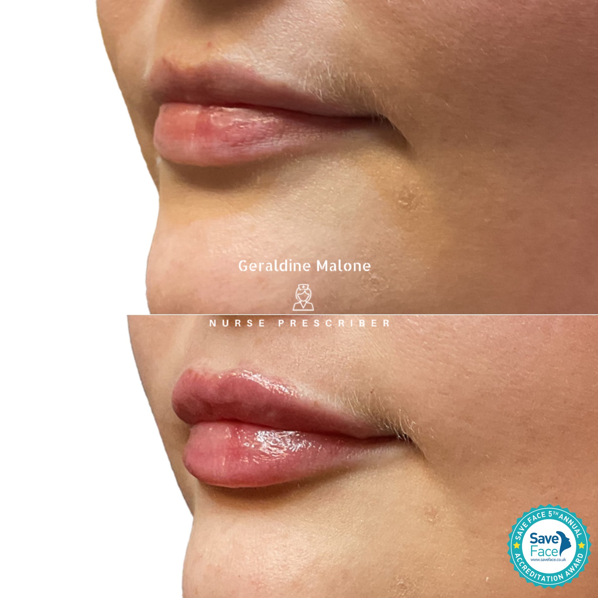 ✨ Signature Lip Enhancement ✨
Refine your look with a treatment designed to deliver volume, enhance hydration, and beautifully balanced proportions — all while preserving your natural individuality.
💉 Treatment Options:
0.5ml — £145
1ml — £225
⏱ Recovery: 24–48 hours
⏳ Results: 6–12 months
Real results only — no edited images.
Your treatment will be delivered with the highest level of care by Nurse Prescriber Geraldine Malone in a Save Face Registered Clinic.
👉 geraldinemalone.co.uk/book-appointment
📞 Private Enquiries
☎️ 024 7792 1812
📧 geraldinemaloneaesthetics@outlook.com