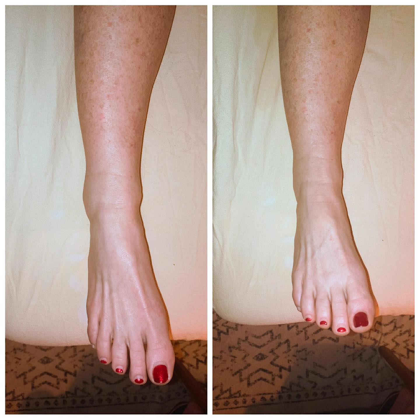 Low-Level Laser Therapy — what’s the big deal? ✨
Low-level laser therapy (LLLT) has been studied for over 30 years, with hundreds of clinical studies supporting its safety, effectiveness, and non-invasive nature for pain, inflammation, and tissue healing — in both humans and animals.
The MicroLight Laser System continues to advance the field of pain management by supporting the body’s natural healing response.
👇 Real-life example:
This patient sprained her ankle yesterday. After just 10 minutes of LLLT, you can already see a noticeable reduction in swelling alone.
✨ Results vary, but the goal is always the same — reduce inflammation, support healing, and help the body recover more efficiently.
Curious how low-level laser therapy could support your healing?
📩 Message me or comment LASER below to learn more.