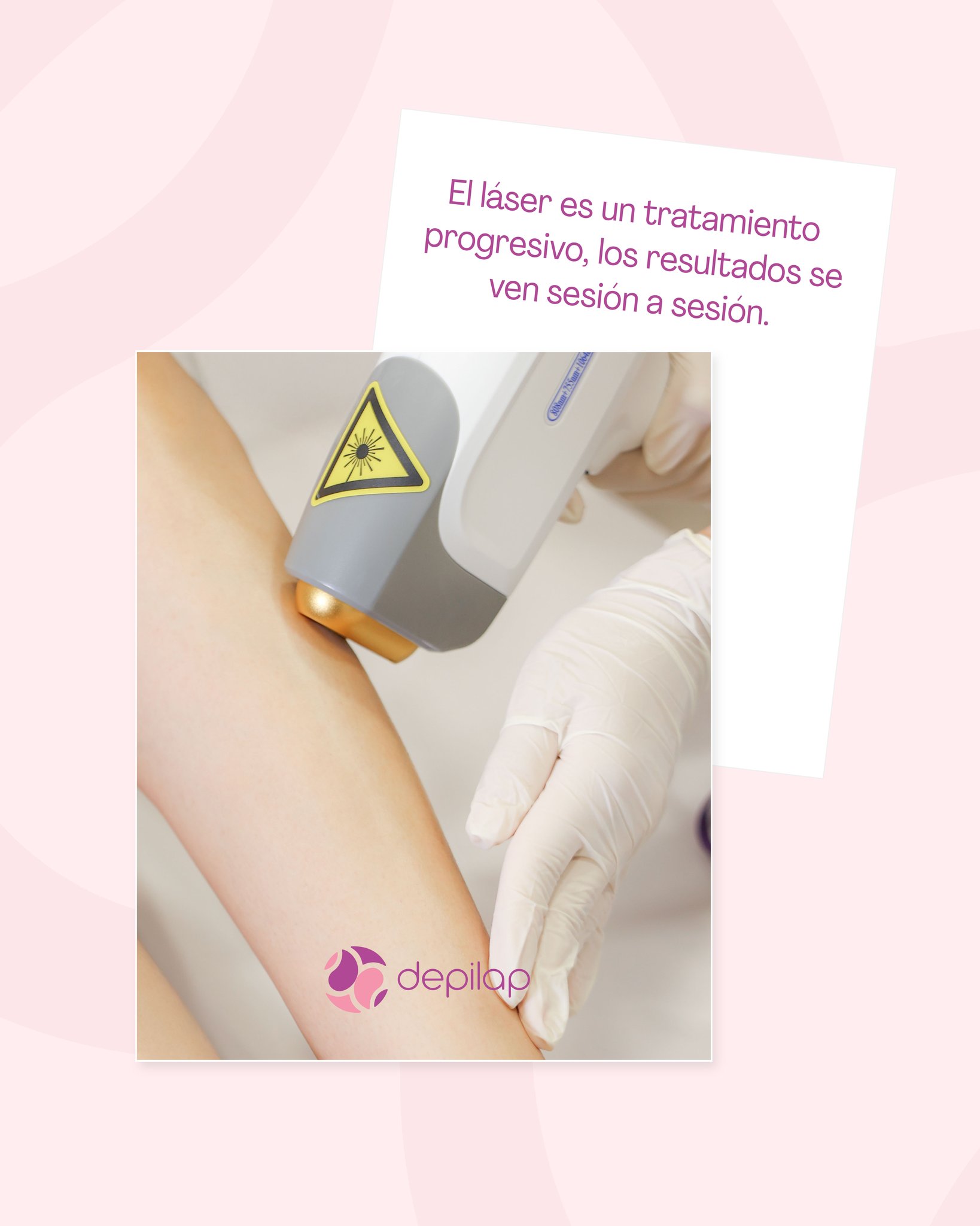 La depilación láser no es magia instantánea, es constancia ✨ Es un tratamiento progresivo que trabaja desde la raíz, por eso los cambios reales se notan con cada sesión.
Menos vello, crecimiento más lento y una piel más uniforme con el tiempo 🤍 La clave está en la disciplina y en hacerlo de forma correcta.
#Depilap #DepilacionLaser #LaserRD