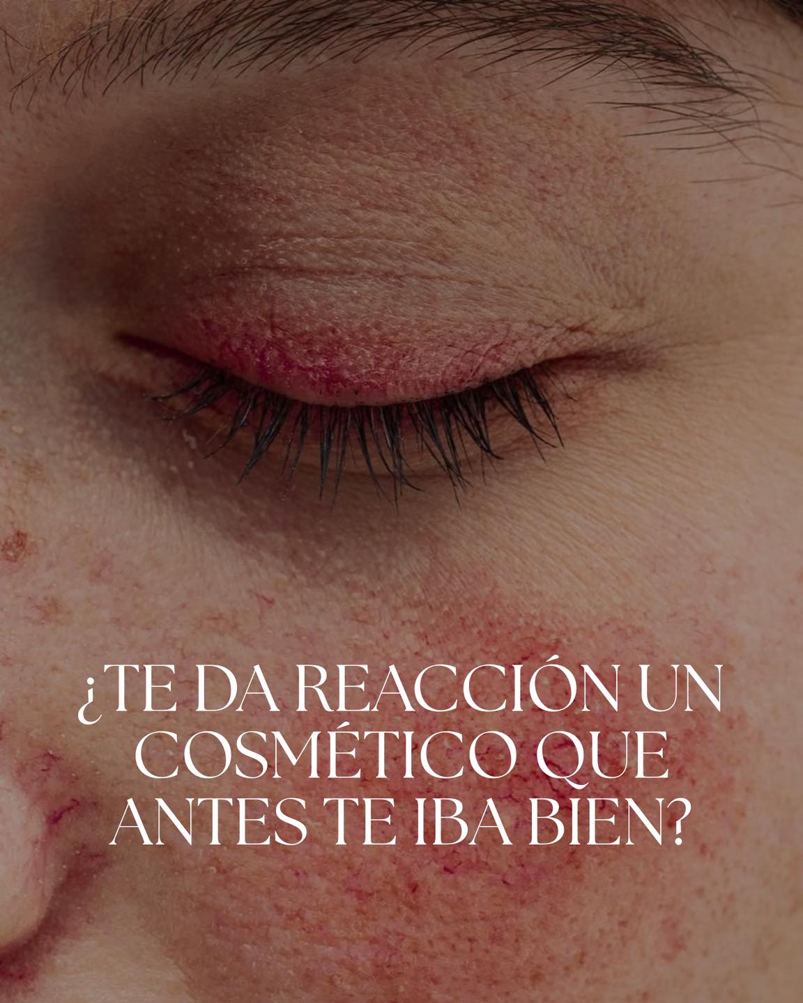 ¿Que hacer si sospechas que tu cosmético puede estar dañando tu piel? Podríamos estar ante una dermatitis de contacto.
Puede ser de origen irritativo (el producto está siendo demasiado agresivo o no es compatible con tu piel) o puede ser de origen alérgico (algún ingrediente del producto provoca una inflamación que suele ser tardía …no aparece en el momento).
En estos casos solemos acumular miles de cremas hasta consultar con un dermatólogo. El problema es que un mismo ingrediente puede estar presente en varios productos.
No pruebes más cremas al azar, agenda una cita con nuestro equipo de expertos en Dermoalergia para una valoración y tratamiento especializado.