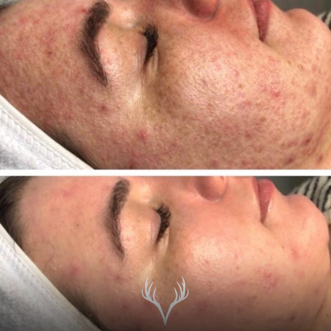 ✨ Vorher / Nachher – wenn Hautarbeit wirklich sichtbar wird ✨
Dieses Ergebnis ist kein Zufall –
es ist das Resultat aus Geduld, Know-how und konsequenter Hautpflege.
Bei dieser Kundin war die Hautstruktur sehr uneben, dazu kamen deutliche Entzündungen.
Genau hier braucht es keine aggressiven Methoden, sondern ein klares, durchdachtes Konzept.
🔬 Was wir gemacht haben:
💧 regelmäßige Hydrafacial-Behandlungen (3 Wochenabstand)
🍫 gezielter Einsatz des Circadia Coco Enzyme Peels als Add On
🧴 eine intensiv abgestimmte Heimpflegeroutine
✨ Das Ergebnis:
– sichtbar ruhigere Haut
– deutlich verfeinerte Hautstruktur
– reduzierte Entzündungen
– ein insgesamt klareres, gesünderes Hautbild
💡 Wichtig zu verstehen:
Solche Ergebnisse entstehen nicht über Nacht.
Sie entstehen durch Konsequenz, richtige Wirkstoffe und realistische Zielsetzung.
🤍 Haut kann sich verändern – wenn man ihr die richtigen Bedingungen gibt.
📞 Termine bitte telefonisch oder über unser Online-Buchungstool
📍 Beauty Bar Baden