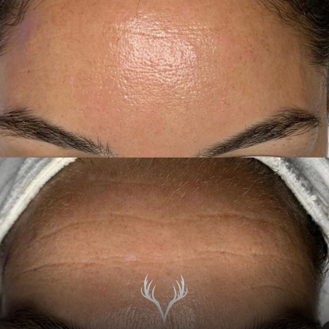 ✨ Vorher / Nachher – Anti-Aging an der Stirn ✨
Dieses Ergebnis zeigt, was möglich ist, wenn Hautalterung gezielt und professionell behandelt wird.
Die Stirn wirkt nach der Behandlung sichtbar glatter, feiner und insgesamt entspannter.
🔬 Was hier passiert ist:
– gezielte Anti-Aging-Behandlung
– Fokus auf Feuchtigkeit, Hauterneuerung & Strukturverbesserung
– Stimulation statt Überreizung
✨ Das Ergebnis:
– deutlich reduzierte Faltentiefe
– glattere, prallere Haut
– frischeres, erholteres Gesamtbild
💡 Wichtig zu wissen:
Anti-Aging bedeutet nicht „Falten komplett löschen“, sondern
👉 die Haut nachhaltig zu stärken, damit sie wieder besser arbeitet.
Mit regelmäßigen Behandlungen und abgestimmter Heimpflege lassen sich solche Ergebnisse aufbauen und erhalten.
📍 Anti-Aging Behandlungen in Baden
📞 Termine bitte telefonisch oder über unser Online-Buchungstool
Beauty Bar Baden
#antiagingbaden #faltenreduktion #stirnfalten #hautverjüngung #beautybarbaden #facialbaden #hautpflegebaden #clearskin #glowingskin #professionellehautpflege #skincarebaden