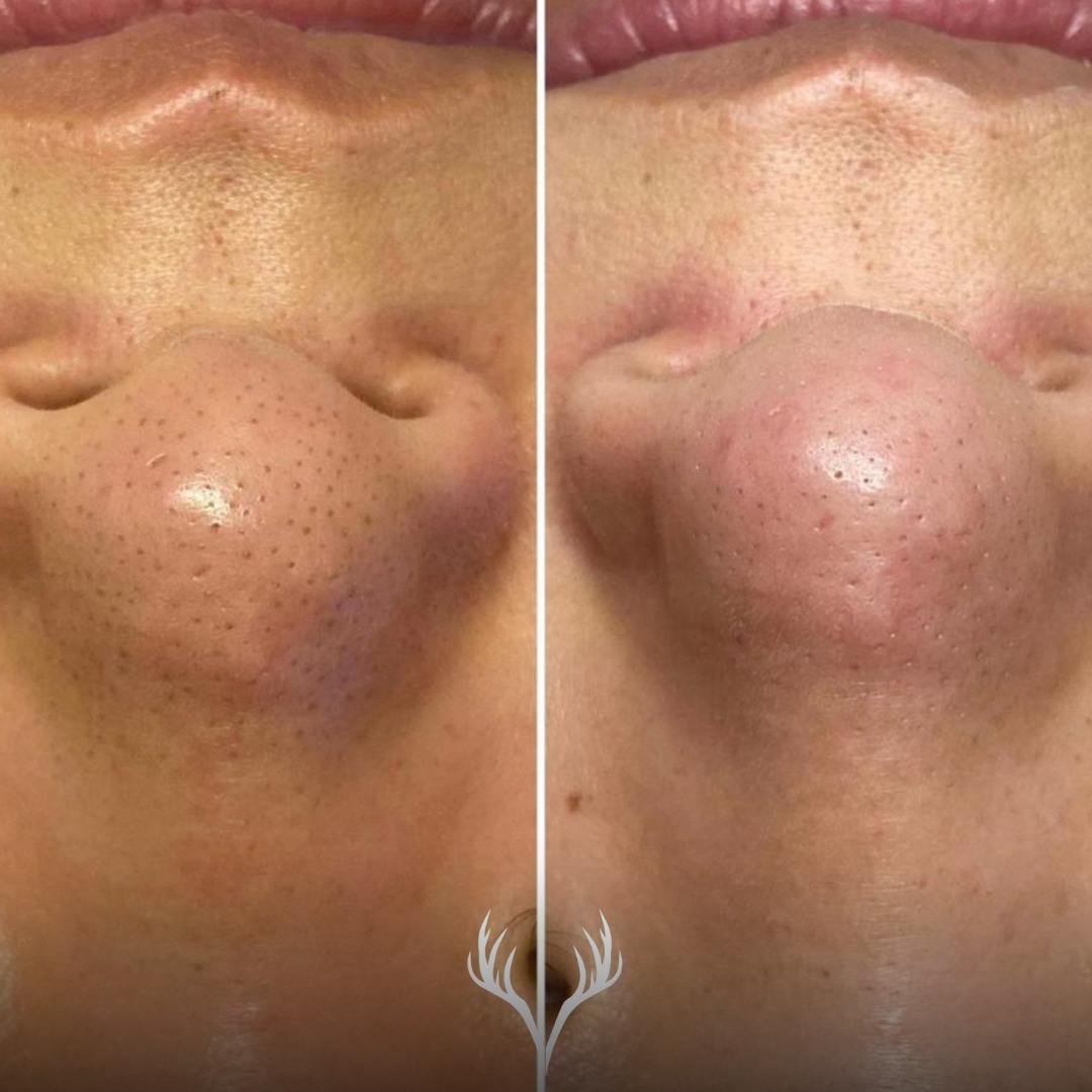 ✨ Vorher / Nachher – Porenpflege, die man sieht ✨
Die Nase ist einer der Bereiche, in denen sich Talg und Ablagerungen besonders schnell sammeln.
Was hier oft als „Mitesser“ wahrgenommen wird, sind in Wahrheit meist Sebumfilamente – ein völlig normaler Bestandteil gesunder Haut.
💧 Was wir hier gemacht haben:
– sanfte, professionelle Ausreinigung
– porentiefe Reinigung mit Hydrafacial
– Beruhigung & Balance statt aggressivem Drücken
✨ Das Ergebnis:
klarere Poren, ein ruhigeres Hautbild und ein insgesamt frischer Eindruck – ohne die Haut zu stressen.
💡 Wichtig zu wissen:
Sebumfilamente bilden sich wieder nach. Das ist normal.
Regelmäßige Behandlungen und die richtige Heimpflege sorgen dafür, dass die Poren fein, sauber und unauffällig bleiben.
📍 Hydrafacial & Porenreinigung in Baden
📞 Termine bitte telefonisch oder über unser Online-Buchungstool
Beauty Bar Baden
#hydrafacialbaden #porenreinigung #sebumfilamente #nasevorhernachher #hautpflegebaden #beautybarbaden #facialbaden #clearskin #glowingskin #professionellehautpflege #skincarebaden #ohnefilter