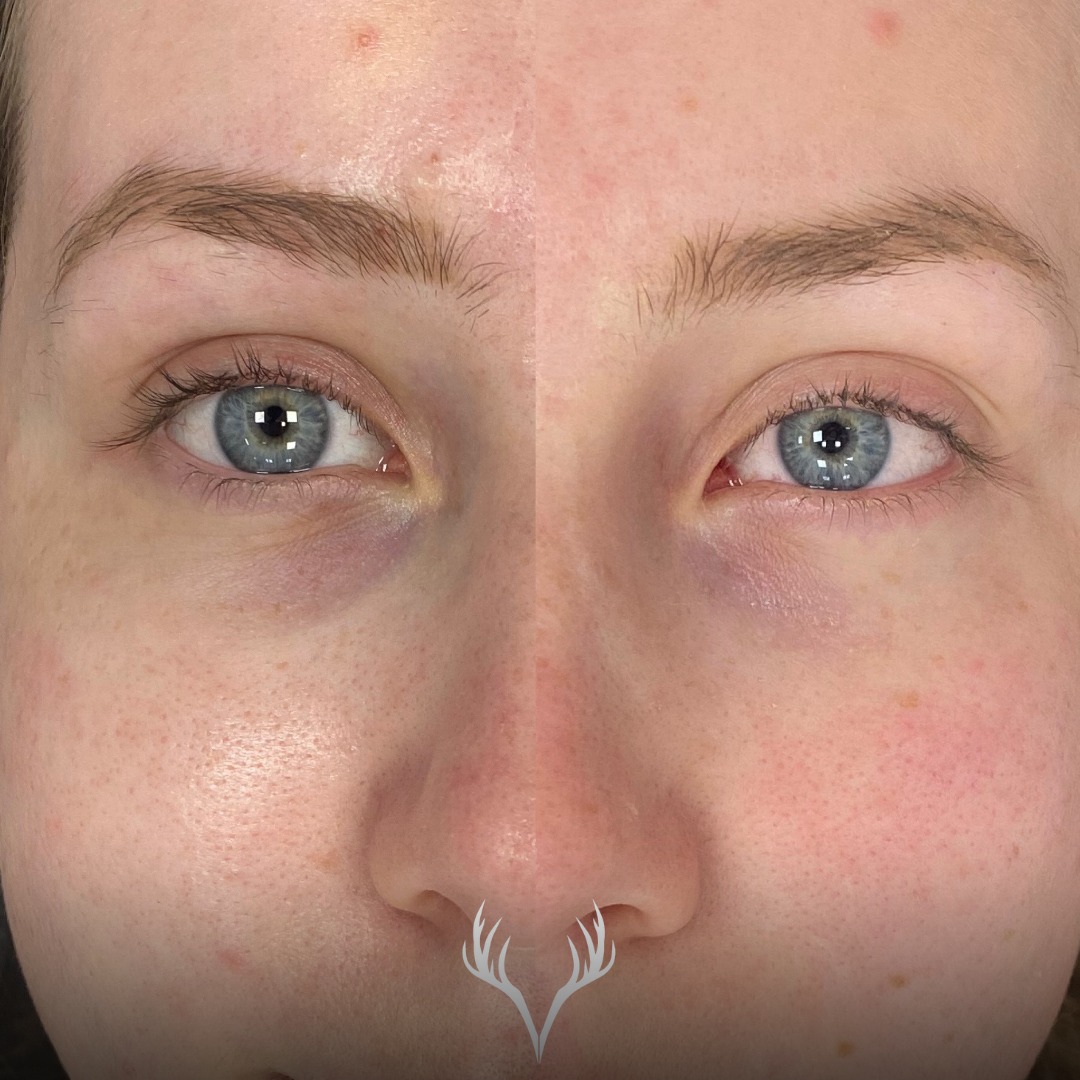 ✨ Vorher / Nachher – Augenringe, die wirklich heller wirken ✨
Bei dieser Kundin waren die bläulichen Augenschatten deutlich sichtbar – ein Hautbild, das oft genetisch bedingt ist oder durch Gefäßdurchschimmerung entsteht.
Umso schöner, wenn man sieht, was gezielte Behandlungen bewirken können.
🔬 Das Ergebnis:
– sichtbar aufgehellte Augenpartie
– frischer, wacher Blick
– insgesamt harmonischeres Hautbild
💡 Wichtig zu wissen:
Augenringe entstehen nicht über Nacht – und verschwinden auch nicht nach nur einer Behandlung.
Je nach Ausgangslage braucht es ca. 3–6 Behandlungen, um Schritt für Schritt zum Traumergebnis zu kommen.
✨ Die Behandlung:
– sehr gut verträglich
– schmerzarm
– speziell auf die empfindliche Augenpartie abgestimmt
🤍 Gerade bei bläulichen Augenringen ist Kontinuität der Schlüssel – und realistische Aufklärung genauso wichtig wie schöne Ergebnisse.
📞 Termine bitte telefonisch oder über unser Online-Buchungstool
📍 Beauty Bar Baden