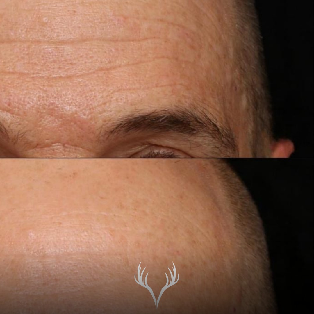 ✨ Vorher / Nachher – Stirnfalten bei unserem männlichen Kunden ✨
Dieses Ergebnis zeigt sehr schön: Anti-Aging ist keine Frage des Geschlechts, sondern der richtigen Strategie.
Die Stirn wirkt nach der Behandlung deutlich glatter, ruhiger und frischer – ohne unnatürlich auszusehen.
🔬 Was hier entscheidend war:
– gezielte, regelmäßige Behandlungen
– Fokus auf Feuchtigkeit, Hauterneuerung & Struktur
– eine konsequente, passende Heimpflege
💡 Ganz wichtig:
Solche Ergebnisse entstehen nicht durch eine einzelne Behandlung.
Erst die Kombination aus Regelmäßigkeit im Studio und disziplinierter Pflege zu Hause macht den Unterschied – besonders bei Männerhaut, die oft kräftiger, aber auch anspruchsvoller ist.
✨ Gepflegte Haut wirkt souverän, frisch und gesund – im Alltag wie im Beruf.
📍 Anti-Aging & Facials für Männer in Baden
📞 Termine bitte telefonisch oder über unser Online-Buchungstool
Beauty Bar Baden
#antiagingmänner #stirnfalten #vorhernachher #hautpflegemänner #facialbaden #hydrafacialbaden #beautybarbaden #männerhaut #hautverjüngung #professionellehautpflege