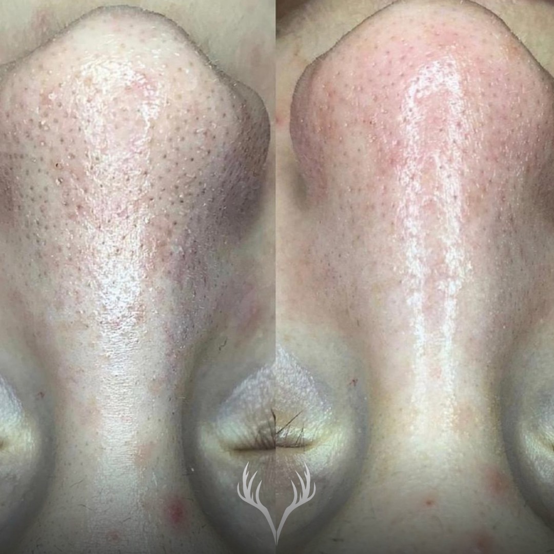 🖤 Vorher / Nachher – Hydrafacial & ausgereinigte Nase ✨
Dieses Ergebnis lieben wir – aber Aufklärung ist uns genauso wichtig wie Glow.
Was du hier siehst, sind gereinigte Poren bzw. Sebumfilamente. Und ja: sie kommen wieder. Das ist völlig normal.
🔬 Kurz erklärt:
Sebumfilamente bestehen aus Talg und Hornzellen und sitzen in den Poren. Sie sind keine Mitesser, sondern ein natürlicher Teil der Hautfunktion. Ziel ist nicht, sie „für immer zu entfernen“, sondern sie sauber, fein und unauffällig zu halten.
💧 Warum Hydrafacial so gut wirkt:
– porentiefe Reinigung
– sanfte Abtragung abgestorbener Hautschüppchen
– Ausgleich der Talgproduktion
– sofort sichtbar glattere, klarere Haut
⏳ So hält das Ergebnis möglichst lange:
✔️ regelmäßige Behandlungen
✔️ konsequente Reinigung zu Hause
✔️ keine aggressiven Produkte oder ständiges „Herumdrücken“
✔️ gute Feuchtigkeitsversorgung (auch ölige Haut braucht Feuchtigkeit!)
✔️ Sonnenschutz – ja, auch für die Nase
🚫 Wichtig:
Wenn Sebumfilamente nach einiger Zeit wieder sichtbar werden, ist das kein schlechtes Ergebnis, sondern ein Zeichen dafür, dass deine Haut ganz normal arbeitet.
✨ Hydrafacial bringt deine Haut immer wieder zurück in Balance – und genau darum geht es.
📞 Termine bitte telefonisch oder über unser Online-Buchungstool
📍 Beauty Bar Baden