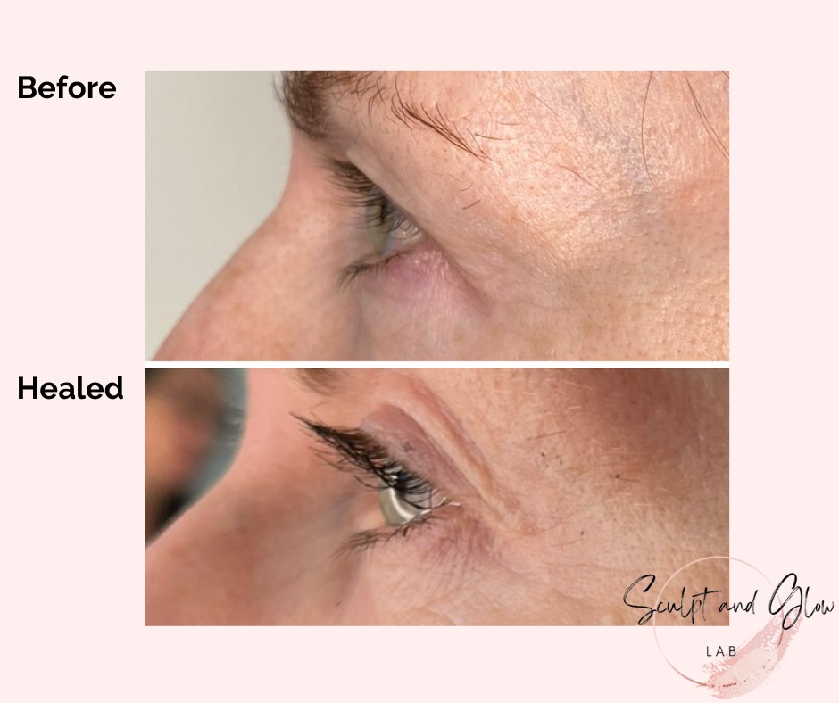 ⚡️The Power of Plasma Fibroblast⚡️
Check out these AMAZING healed results of Plasma Fibroblast to the upper eye lids!! INCREDIBLE!! 👏
Too frightened to go under the knife?
Are your hooded eyes bothering you?
Plasma Fibroblast may be the answer you have been searching for! 🙌
Starting from $299*, which includes treating the crows feet!
DM now to secure your FREE consultation with Hayley who is 2x certified in #plasmafibroblast using a government approved Plaxpot Plasma Pen! 💜
*Treatment isn't suitable for everybody. Contact @sculptandglowlab for further information. Strict pre & post treatment care MUST be followed.
.
#plasmafibroblastperth #plasmatreatment #nonsurgicalupperblepharoplasty #skintightening #laxskintreatment #glowingskin #aginggracefully #nurseledclinic #sculptandglowlab #plaxpotplasmapen