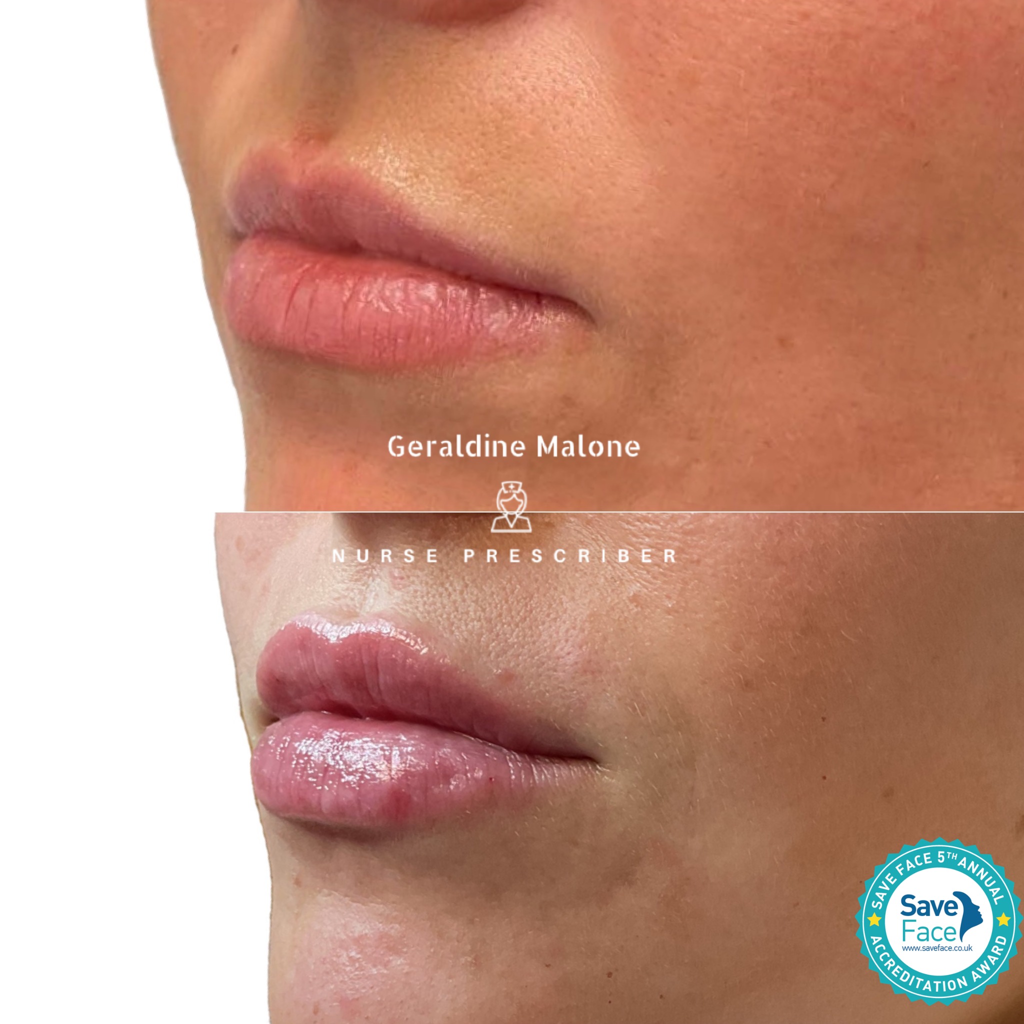 ✨ 0.5ml Lip Enhancement
Subtle volume. Deep hydration. Natural balance.
💉 0.5ml £145 | 1ml £225
⏱ 24–48hr recovery
⏳ Results last 6–12 months
✔️ No edited images
Performed by Nurse Prescriber Geraldine Malone
Save Face Registered Clinic
📅 Book your appointment here:
👉 geraldinemalone.co.uk/book-appointment
📞 Contact
☎️ 024 7792 1812
📧 geraldinemaloneaesthetics@outlook.com