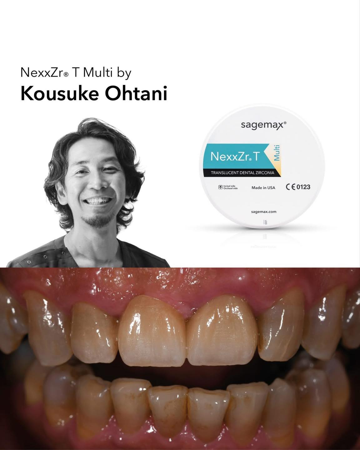 الدقة تلتقي بالجمال! كوسوك وهتانا يستخدم التدرج السلس ل - NexxZrT Multi ليحقق هذا المظهر الطبيعي المذهل. عمل استثنائي! 👏🏻👏🏻👏🏻
ديسكات الملتي متوفرة بمقاسات مختلفة .
14,16,20,25mm
جميع الالوان متاحة! و عروض خاصة !
@sagemax official
لمزيد من المعلومات و للاستعلام اتصل بنا : 24513870 - 24513874
#sagemax #dentalwork #dentallab #dentaltechnician #dentalphotography #nexxzrtmulti #dentistry #technikdentystyczny #dentalinspiration #عيد_و_كبريته #زركونيا_ديسك #جودة_تثق_بها #جودة_عالية