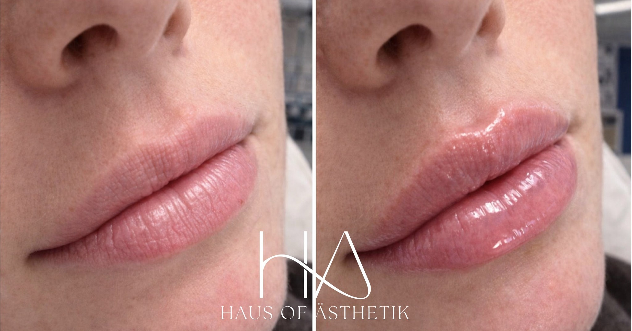 Perfect your pout for Valentine's and Galentine’s day 💋
With Valentine’s Day approaching, this patient attended the clinic to improve lip hydration, softness and surface texture using a non-volumising approach, ideal for those wanting naturally healthy lips rather than added size.
💉 Treatment: mesoestetic® next lips
📍 Area Treated: Lips and perioral area
🔁 Number of Sessions: 1 (course options discussed)
⏱ Procedure Time: 30 minutes
🧊 Downtime: Minimal – mild redness or sensitivity may occur for 24–48 hours
🪄 Result: Improved hydration, smoother texture and a soft, natural gloss effect
mesoestetic® next lips is designed to deeply hydrate and revitalise the lips by improving water retention and skin quality, without adding volume or altering natural shape. The result is lips that look healthier, smoother and naturally conditioned, perfect for winter and the weeks leading up to Valentine’s Day.
An excellent option for patients wanting subtle enhancement, maintenance between injectable treatments, or a gentle introduction to aesthetic procedures.
Swipe to see the results:
📸 Left = Before | Right = Immediately After Treatment
✅ Patient consented to the use of these images for educational and promotional purposes.
📍 Haus of Ästhetik
4 Portland Square, Bakewell, DE45 1HA
📞 01629 385318
🌐 www.hausofasthetik.co.uk
📩 DM us to book your consultation
#Lips #MedicalAesthetics #HausOfAsthetik #BakewellClinic #DermalFiller #Lipfiller #ValentinesDay #GalentinesDay