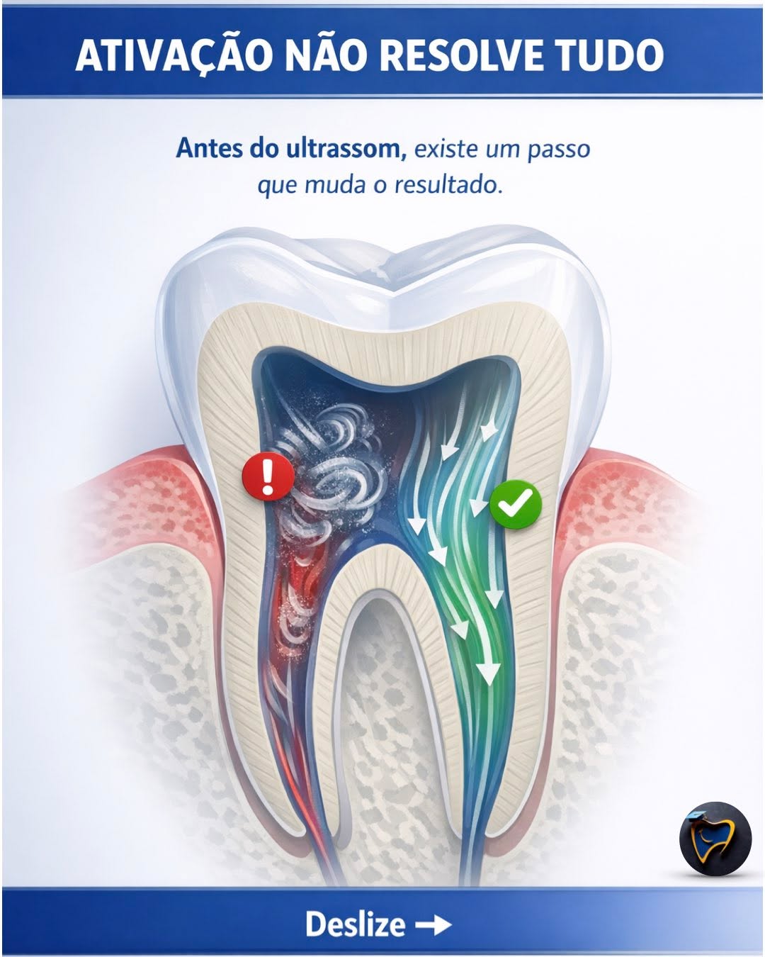 ATIVAÇÃO NÃO RESOLVE TUDO. ⚠️
Se a sua irrigação “não rende”, o problema pode estar antes do ultrassom — e não no equipamento.
💡 O segredo está no caminho:
✅ Glide path → o irrigante consegue circular (menos “zonas paradas”).
✅ Preparo cervical → o fluxo destrava (mais penetração, menos resistência).
✅ Equilíbrio apical → nem “apertado demais”, nem “aberto demais”.
📌 Moral clínica: quando o canal está bem preparado, a ativação precisa de menos força para alcançar mais resultado — com mais segurança.
🔎 Quer o passo a passo completo (com lógica clínica e aplicação prática)?
👉 Leia no blog: LINK na BIO
💬 Comente IRRIGAÇÃO que eu envio o link também.
📌 Salve este post para usar como checklist no próximo caso.
#endodontia #irrigaçãoendodôntica #glidepath #preparocervical #ultrassomodontologia #odontologia #endodontics #dentista #canalradicular
@abo.rondonia @hdensinosoficial @aorp1946 @apcdararaquara
@thaischriscunha @pascoalinodoc @martinmeirelles @daniedison @nellyslanzc @dragiovanastraciab @samia_odonto @anaclarazanutto @anacarlaresende_
@victorhsilva14 @theodoro_cassia @walleskalima_
@laauraeliisa @dra.biancachicote
@ma.segatto @guiilhermecruz @guimartinelli97 @vitin_mart