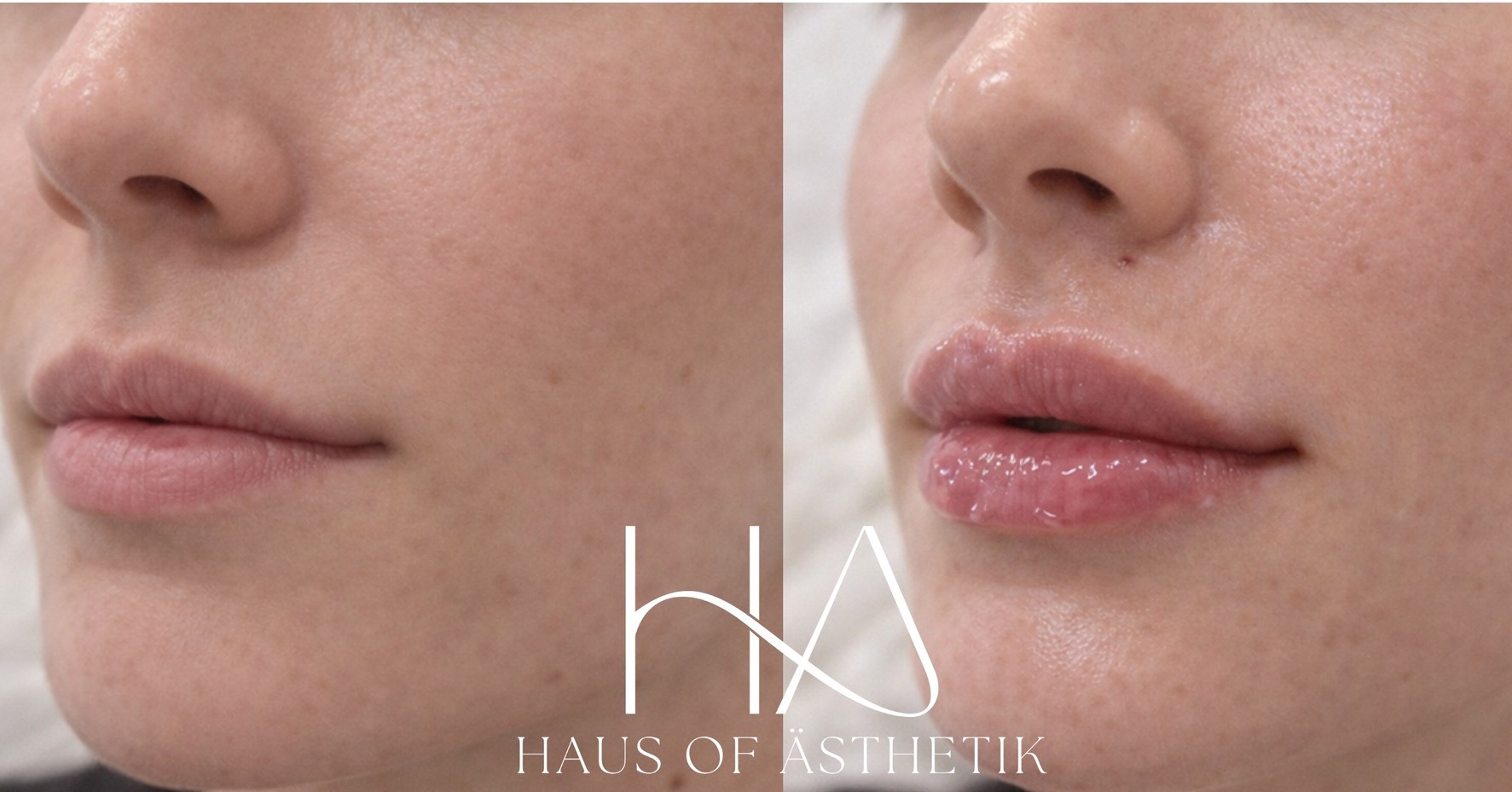 💋 Your lips but better: Achieving the ultimate natural pout this Valentine’s Day 💋
This fantastic patient wanted a subtle, natural enhancement, and that’s exactly what we delivered.
Using 0.7ml of Teoxane Kiss, we created soft volume, refined her natural lip shape, and boosted hydration without overfilling. The result? Balance, symmetry, and that effortlessly kissable glow.
🧪 Treatment: 0.7ml Teoxane Kiss hyaluronic acid lip filler
Whether it’s your first time or a perfect pre-Valentine’s top-up, we’re here to make your lips feel like you, only better.
📞 01629 385318
📩 DM to book your consultation
🖥 www.HausOfAsthetik.co.uk
📸 Left: Before | Right: After
✅ Patient consented to image use for promotional and educational purposes
Disclaimer: Every face is different, treatment plans and results will vary depending on individual needs and assessment.
#ValentinesLips #YourLipsButBetter #LipFiller #Bakewell #TeoxaneKiss #KissableLips #LipFillerResults #NaturalLipFiller