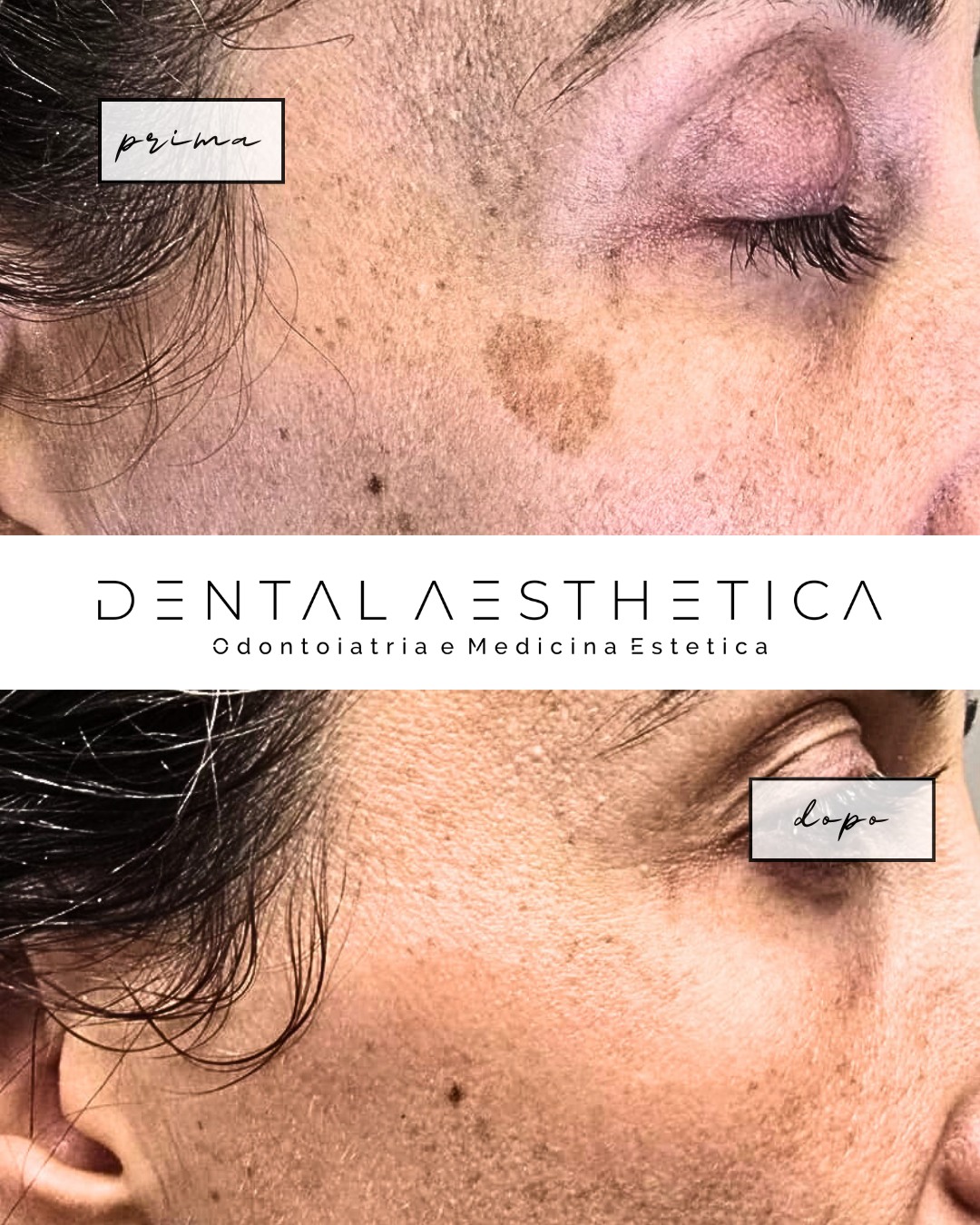 Puoi tenerla addosso tutta la vita.
O puoi toglierla.
Dental Aesthetica
💫Odontoiatria e Medicina Estetica
📍viale della Grande Muraglia 256, zona EUR-Torrino
📱375 88 47 069