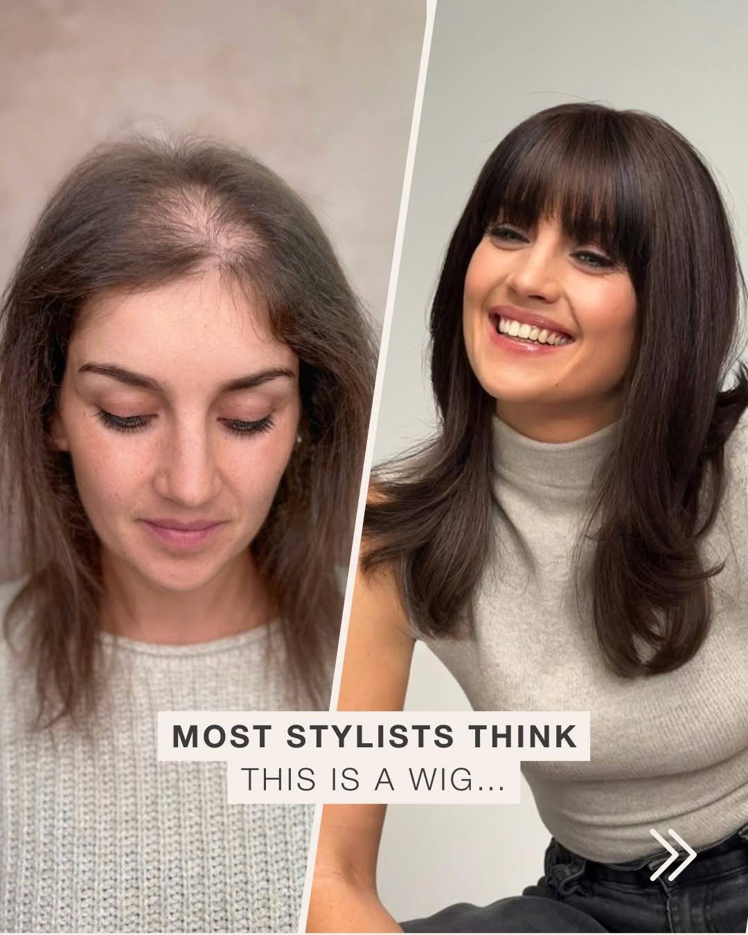 Feel free to share this with anyone who has very fine or thinning hair and would love to make a change – without any limitations. 🫶
The MicroLines FreeStyle is a very special variation of our MicroLines system:
➤ a flexible parting as its unique feature
➤ complete styling freedom – every hairstyle is possible
➤ maximum flexibility for everyday life
Infos: +352 530404
#byTun #bytunshop
#hairdreams