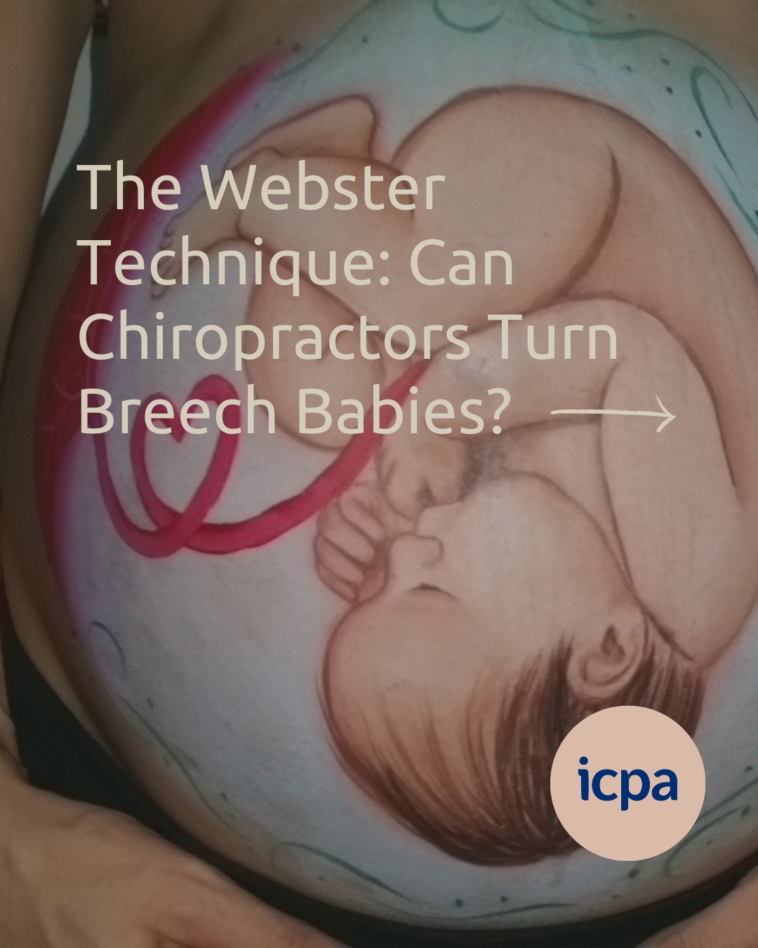 Breech baby? đś
The Webster Technique is designed to create more balance and space in the pelvisâgiving baby the best chance to turn head down naturally. đŤ
.
.
.
#wildbloomchiro #gallatintn #sumnercounty #baby #breech #chiropractor #webster