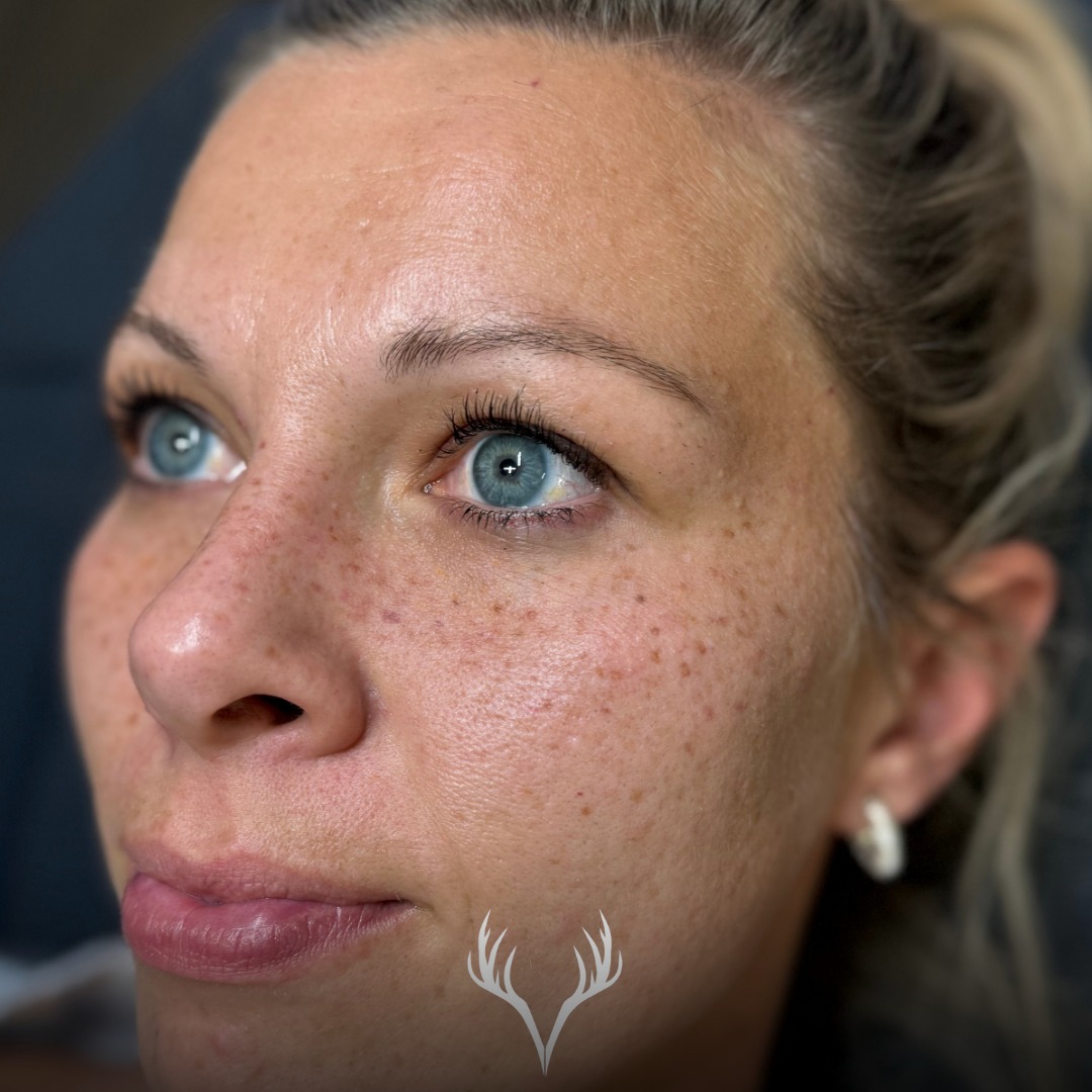 Hier siehst du ein Ergebnis von einer Kundin, die ihre Fake Freckles bei uns schon zum zweiten Mal auffrischen hat lassen 🤎✨
Ich sag’s wirklich immer wieder: Ich liebe Refresh-Termine.
Warum? Weil Freckles mit jedem Mal noch natürlicher wirken.
Was dabei passiert, ist ganz logisch (und genau das macht den Look so schön):
• die „alten“ Freckles werden mit der Zeit heller und softer
• die frisch gestochenen wirken anfangs etwas satter
• dadurch entsteht ein 3D-Effekt – Tiefe, Dimension und dieser echte „Sun-kissed“-Vibe
Das ist kein Nachstechen im Sinne von „dunkler machen“ – sondern ein bewusstes Layering für mehr Natürlichkeit. Und genau so sollen Fake Freckles aussehen: wie echte, die du schon immer hattest. ☀️
Wenn du dir Sommersprossen wünschst (oder deine auffrischen möchtest): Wir beraten dich ehrlich, wie viel bei deiner Haut sinnvoll ist – damit’s am Ende nicht „gemacht“ aussieht, sondern einfach nach dir.
📍 Beauty Bar Baden – Fake Freckles / PMU
📞 Termine telefonisch oder über unser Online-Buchungstool
#fakefreckles #frecklesrefresh #sommerprossen #pmufreckles #permanentmakeupbaden #beautybarbaden #badenbeiwien #natürlicherlook #sun kissed #pmuartist #freckleslover #beautyconfidence #browsandbeauty #pmuliebe #dearbeauty