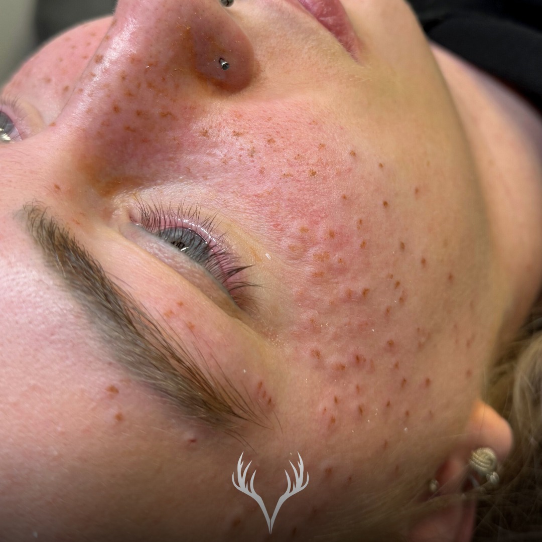 So sehen Fake Freckles direkt nach dem Stechen aus: maximal unnatürlich 😅
Rot, leicht geschwollen und viel dunkler als das Endergebnis. Und ja – das gehört so. 🤎
Die Abheilung ist bei Freckles wirklich ein Prozess, dem man vertrauen muss. Hier ein paar Fakten, die vielen helfen, entspannt zu bleiben:
✨ Warum sind sie am Anfang so dunkel?
Weil das Pigment frisch in der Haut sitzt und die Haut rundherum mit Rötung/Schwellung reagiert. In den ersten Tagen wirken Freckles deshalb oft „zu viel“.
🧬 Freckles leben von „Weichheit“
Echte Sommersprossen haben keine scharfen Kanten. Genau dieses „soft werden“ passiert erst in der Abheilung, wenn die Haut sich beruhigt und Pigment sanfter wirkt.
⏳ Die große Veränderung kommt nach dem Ablösen
Während der Heilung bildet sich oft ein feiner Schorf/Film. Sobald sich das löst, sehen viele Freckles plötzlich viel heller aus. Das ist normal – und genau deshalb plant man bei Freckles meistens mit einem Refresh, wenn man mehr Dichte möchte.
🌞 Sonne ist in der Abheilung ein No-Go
UV kann die Abheilung stören und das Ergebnis verändern. SPF ist Pflicht, direkte Sonne/Solarium bitte konsequent vermeiden.
🫧 Bitte nicht „wegpflegen“
In der Abheilzeit sind starke Peelings, Retinoide oder aggressive Wirkstoffe im Bereich tabu – wir wollen, dass das Pigment in Ruhe einheilen kann.
🤍 Unser wichtigster Punkt: Erwartungsmanagement
Freckles sind kein „Instagram-Filter“, sondern ein super natürlicher Look, der Zeit braucht. Wer den Prozess versteht, liebt das Ergebnis noch mehr.
Wenn du Freckles willst: Wir klären dich vorher ehrlich auf – damit du weißt, was in den ersten Tagen normal ist und wann du dein echtes Endergebnis beurteilen kannst. ✨
#fakefreckles #frecklespmu #sommerprossen #pmuheilung #abheilung #permanentmakeupbaden #beautybarbaden #badenbeiwien #natürlicherlook #pmutipps #hautpflege #spfistpflicht #freckleslover #pmurealistic #beautyfacts