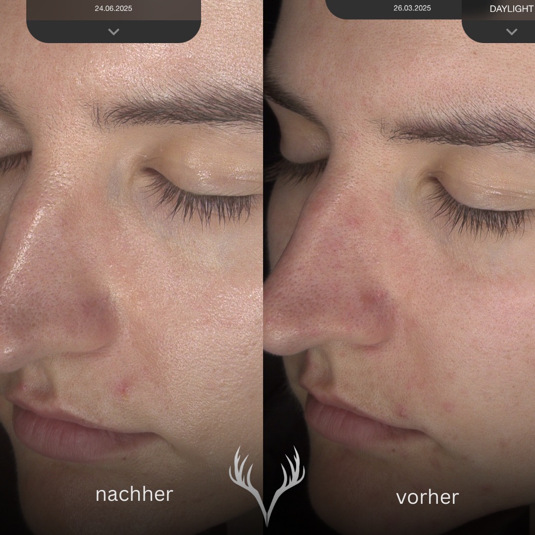 Vorher/Nachher – realistische Erwartungen statt „Social Media Magie“ 🤍
Wir wissen: Auf Social Media catchen vor allem die krassen Transformationen. Aber Hautveränderung ist in echt oft leiser – und genau das möchten wir euch auch zeigen. Kleine, ehrliche Fortschritte, die sich Schritt für Schritt aufbauen.
Denn mit dem freien Auge sieht man manchmal zuerst nur „mini“ Unterschiede. Was viele aber viel schneller merken, ist das Hautgefühl:
✨ glatter, ruhiger, weniger „gestresst“, weniger Spannungsgefühl, insgesamt stabiler.
Auf diesem Vorher/Nachher siehst du genau so einen realistischen Fortschritt:
• das Hautbild ist bereits etwas ebenmäßiger
• rote Stellen sind weniger geworden
• die Haut wirkt deutlich klarer und ruhiger
Das ist der Anfang von echter Hautgesundheit. Und genau dort setzen wir an: beobachten, anpassen, weiterentwickeln – statt zu raten. 🔬
Wenn du auch echte, nachhaltige Hautveränderung willst: wir begleiten dich mit Plan, Fachwissen und ehrlicher Beratung.
📍 Beauty Bar Baden – Hautgesundheit & Skin Transformation
📞 Termine telefonisch oder über unser Online-Buchungstool
#vorhernachher #hautroutine #hautgesundheit #realisticresults #skinprogress #hautbild #rötungenreduzieren #unreinehaut #kosmetikbaden #beautybarbaden #badenbeiwien #facialbaden #observhautalyse #skincarebaden #hautveränderung