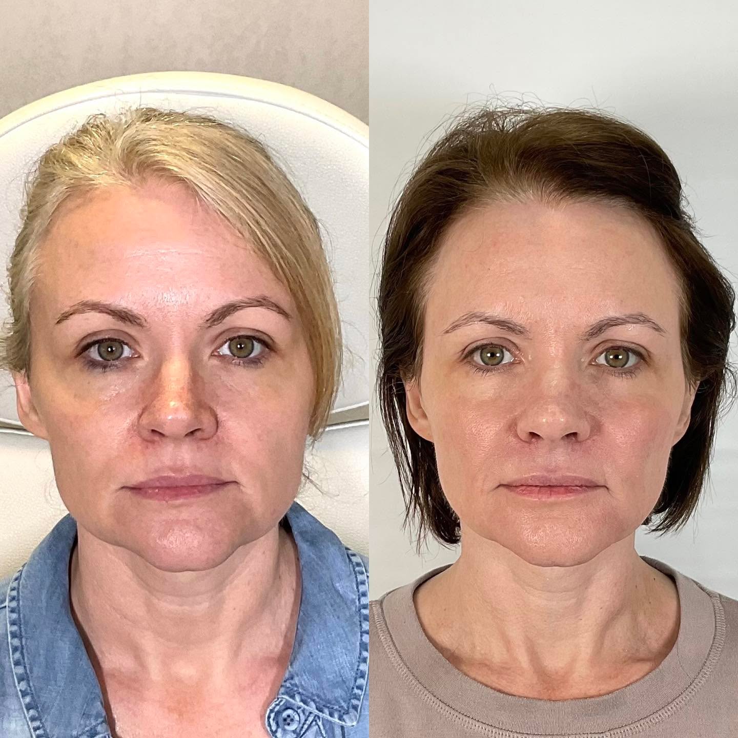 A year can subtly reshape more than you realize.
This B/A is one year apart. Hairstyles change, weight can shift, and your face changes with it, which is exactly why a long-term, maintenance-based approach matters.
This transformation reflects regular neurotoxin, a Sculptra series, and small amounts of thoughtfully placed filler—all working together to support structure, balance, and facial harmony. Nothing overdone. Just steady, strategic care that allows her to look like herself, just refreshed and better.
A reminder that great results aren’t about one appointment. They’re built strategically, over time.
#FacialBalancing #NaturalAesthetics #SculptraResults #InjectablesDoneRight
#SubtleEnhancements #AgingWell #DFWMedSpa #DallasAesthetics
#FĀCAesthetics #ArgyleTX