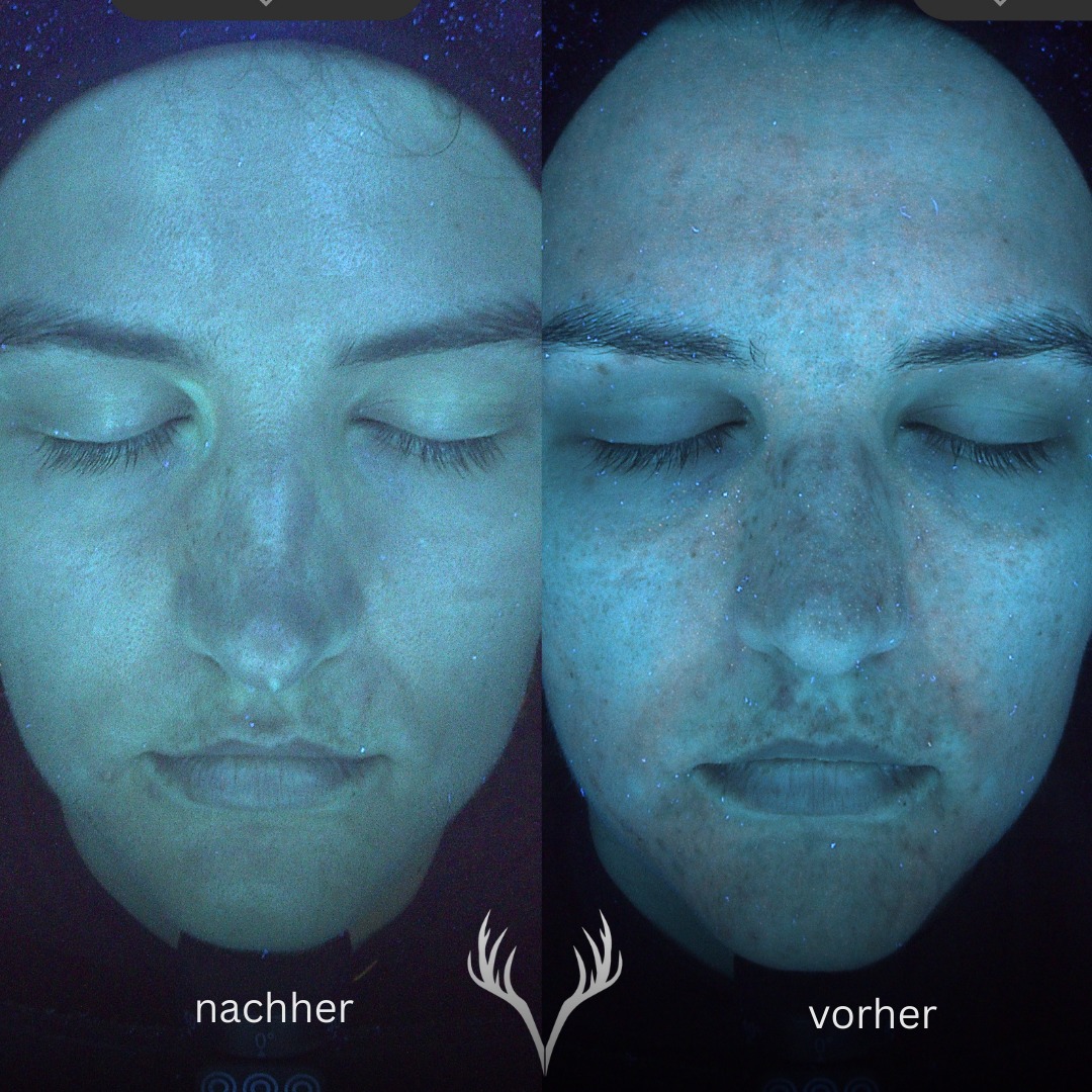 Zwischen diesem Vorher/Nachher liegen 3 Behandlungen – und eine wirklich konsequente Skincare Routine. ✨
Und genau diese Kombination ist der Schlüssel, wenn man echte Hautveränderung will.
Was wir gemeinsam erreicht haben:
• Poren wirken deutlich reiner und „aufgeräumter“
• Hyperpigmentierungen sind sichtbar zurückgegangen
• der Teint ist ebenmäßiger und klarer geworden
Der Grund, warum wir so gezielt arbeiten können: unsere Observ Hautanalyse 🔬
Wir beobachten jede Hautschicht akribisch, tracken Fortschritte und passen Behandlungen + Heimpflege regelmäßig an. Das heißt: kein Rätselraten, kein „wir probieren mal“ – sondern ein Plan, der sich nach deiner Haut entwickelt.
Wenn du dir schnellere, bessere Ergebnisse wünschst, zahlt es sich aus, zu Profis zu gehen.
Wir sind spezialisiert auf Hautveränderung – und wir nehmen dein Ziel ernst. 🤍
📍 Beauty Bar Baden – Hautgesundheit & Skin Transformation
📞 Termine telefonisch oder über unser Online-Buchungstool
#hautveränderung #skintransformation #observhautalyse #observskinanalysis #porenverfeinern #hyperpigmentierung #ebenmäßigerteint #hautgesundheit #kosmetikbaden #beautybarbaden #facialbaden #badenbeiwien #skincarejourney #realresults #spfistpflicht
