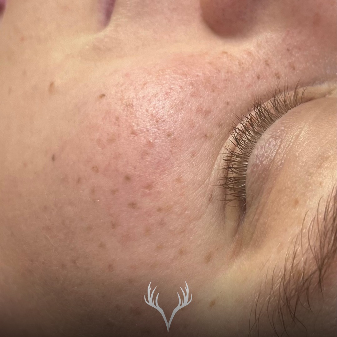 Fake Freckles – so natürlich können sie abgeheilt aussehen 🤎✨
Wenn Sommersprossen richtig gemacht sind, wirken sie nicht „tätowiert“, sondern wie echte, abgeheilte Freckles: weich, unaufgeregt, individuell verteilt – und genau so lieben wir sie.
Aber (und das sagen wir immer ganz ehrlich): Der Hauttyp entscheidet massiv darüber, wie schön und wie „natürlich“ Freckles abheilen können.
Am besten geeignet sind Freckles für:
• kleinporige Haut
• reine, stabile Haut
• nicht ölige Haut / wenig Talgproduktion
Und was ist, wenn deine Haut das Gegenteil ist?
Wir haben viele Kund:innen mit großporiger, öliger Haut – teilweise auch akne- oder entzündungsanfällig. Bei diesen Hauttypen können Freckles natürlich trotzdem gemacht werden, aber: Das Ergebnis ist nicht 1:1 vergleichbar mit einer feinporigen, ruhigen Haut. Pigment verhält sich anders, die Abheilung kann unruhiger sein und die Freckles können schneller „verlaufen“ oder stärker wirken.
Ganz offen: In solchen Fällen würden wir oft lieber zuerst an der Haut arbeiten, bevor wir Freckles stechen – weil eine gesunde, ausgeglichene Haut immer die beste Basis ist.
Aber: Kunde ist König. 👑
Unser Anspruch ist nur, dass du vorher wirklich alles weißt – ehrlich beraten, realistische Erwartungen, saubere Aufklärung. Dann kannst du entscheiden, was für dich richtig ist.
Wenn du dir Fake Freckles wünschst, schau gerne vorbei – wir sagen dir ganz klar, was bei deiner Haut möglich ist. 🤍
📍 Beauty Bar Baden – Permanent Make-up / Fake Freckles
📞 Termine telefonisch oder über unser Online-Buchungstool
#fakefreckles #frecklespmu #sommerprossen #permanentmakeupbaden #pmubaden #beautybarbaden #badenbeiwien #natürlicherlook #kleinporighaut #ölighaut #aknehaut #hautgesundheit #ehrlicheberatung #pmuliebe #freckleslover