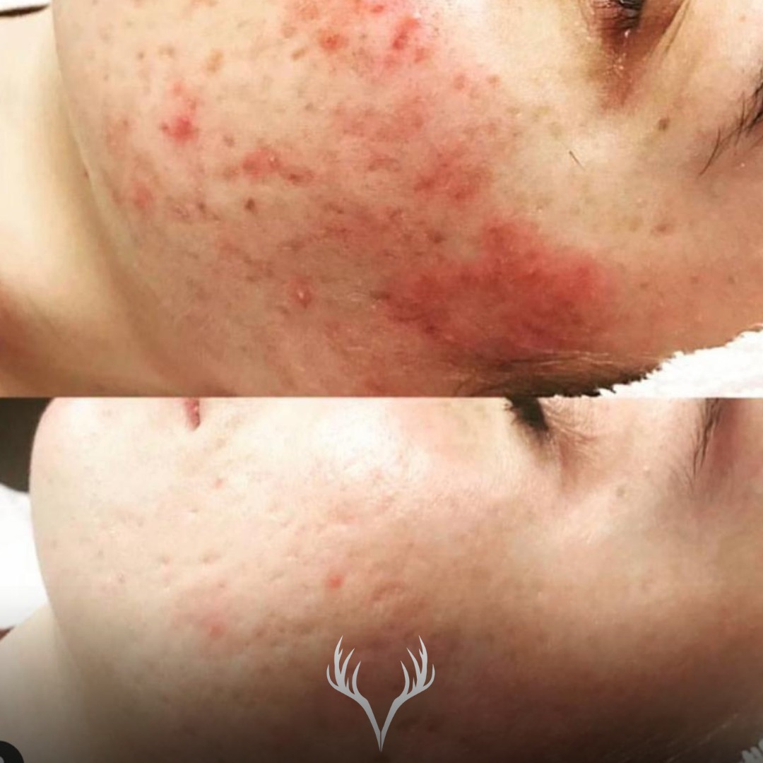 Akne behandeln in Baden – mit System statt „schnell drüber“ 🧡
Wenn Akne stark und vor allem aktiv entzündet ist, braucht die Haut zuerst eines: Beruhigung, Stabilität und einen klaren Plan. Genau dafür haben wir in der Beauty Bar Baden unser Derma Corrective Facial.
Viele glauben, HydraFacial wäre bei Akne automatisch die beste Wahl – bei starker, aktiver Akne ist es bei uns bewusst noch nicht der erste Schritt. Warum? Weil wir erst die Entzündungen runterholen müssen, bevor wir mit apparativen Behandlungen sinnvoll arbeiten können. Hautveränderung funktioniert nicht über Druck, sondern über Strategie. ✨
Derma Corrective Facial = klassische Gesichtsbehandlung mit Circadia
• entzündungsberuhigend & hautbarriereschonend
• individuell angepasst an deinen aktuellen Hautzustand
• inklusive ehrlicher Beratung und einem realistischen Behandlungsplan
• plus: wir bauen mit dir eine Heimpflegeroutine auf, die wirklich machbar ist
Akne ist eines der häufigsten Hautprobleme weltweit – du bist damit nicht allein. Und: du musst da auch nicht allein durch. 🤍
Wir sind bereit, dir zu helfen.
Bist du bereit für Hautveränderung?
📍 Beauty Bar Baden – Hautgesundheit & Akne-Behandlungen
📞 Termine telefonisch oder über unser Online-Buchungstool
#aknebaden #aknebehandlung #hautprobleme #dermacorrectivefacial #circadia #circadiaskincare #kosmetikbaden #beautybarbaden #entzündlicheakne #hautbarriere #unreinehaut #facialbaden #skintransformation #hautgesundheit #badenbeiwien