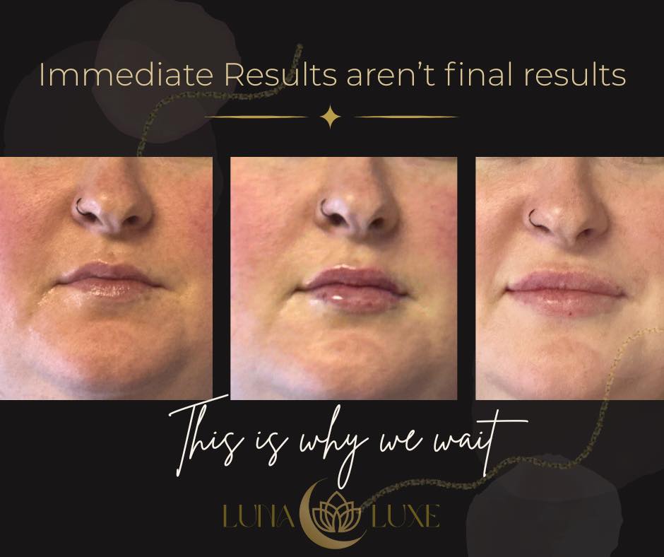 Immediate results aren’t final results.
Swelling settles.
Structure softens.
Balance reveals itself.
This is why we wait.
Because beautiful lips aren’t rushed — they’re refine
