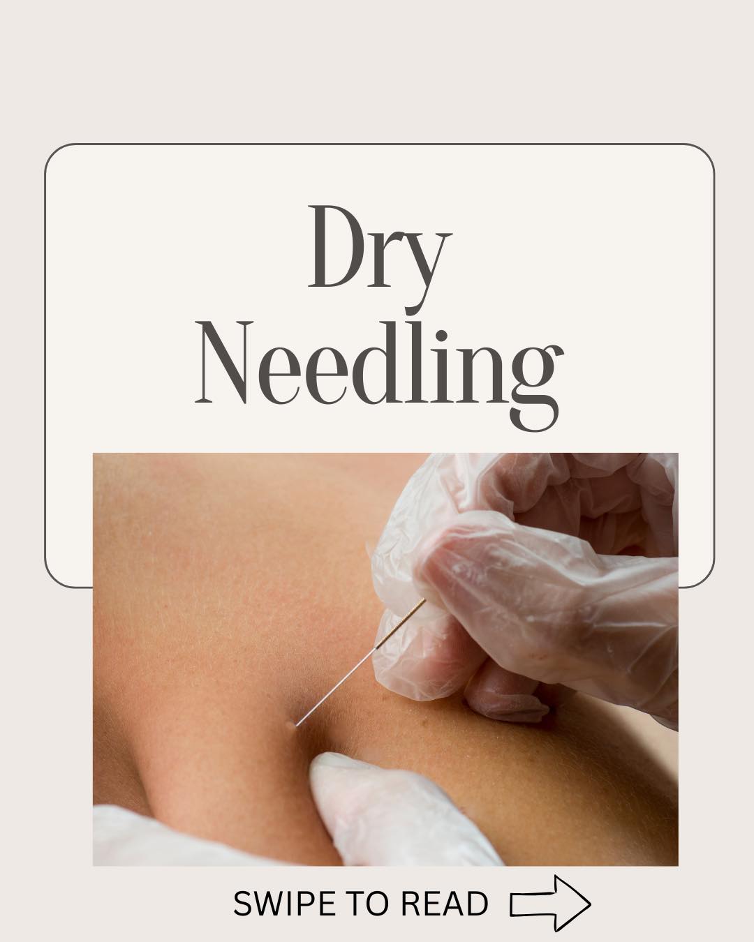 Struggling with tight or sore muscles? Dry needling could help. Read the post for info on it💫
🗓️Make an appointment/ ask questions:
062 662 1361
#chiropracticcare #dryneedling #MusclePainTreatment #musclepainrelief
