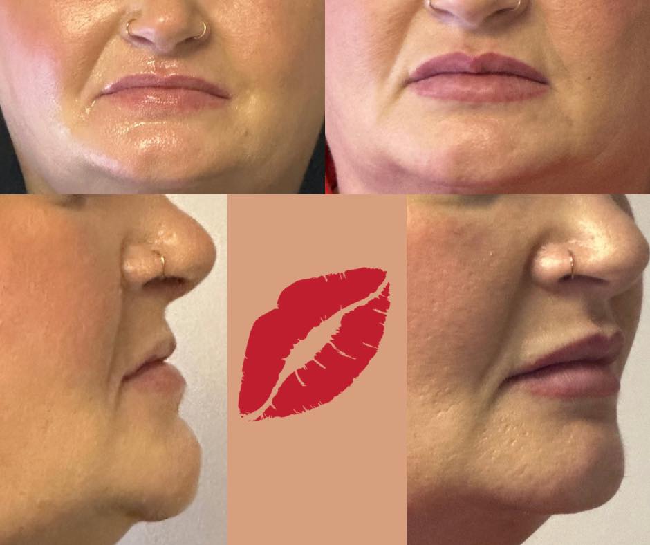 There’s a common misconception that 1 syringe equals “too much.”
That’s not how filler works.
The outcome depends on anatomy, placement, and distribution — not just the amount in the syringe.
This result was achieved with one full syringe
Long-term balance will always outweigh short-term assumption