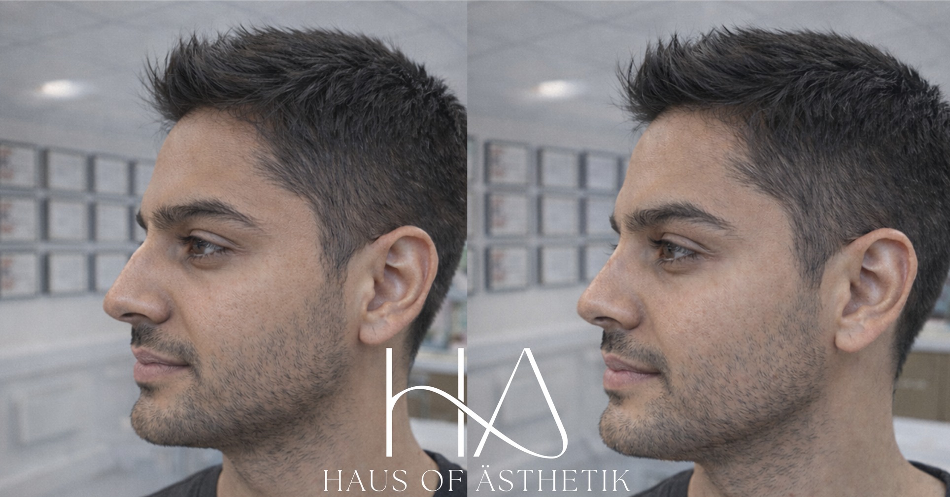 🔹 Transformation Thursday | Liquid Rhinoplasty 🔹
Subtle structure. Serious difference.
Today’s case is a male patient who presented with concerns about a dorsal hump. He did not want surgery. He wanted balance.
This is where non-surgical rhinoplasty, often referred to as liquid rhinoplasty, comes into its own.
What was treated
• Dorsal hump projection
• Profile imbalance
• Light reflection disruption along the nasal bridge
Treatment performed
💉 0.8ml mesoestetic® nexha volume
A cross-linked hyaluronic acid dermal filler combined with succinic acid.
This formulation allows:
• Structural support
• Controlled projection
• Tissue integration
• Reduced inflammatory response
Strategic placement above and below the hump creates a straighter profile line by altering light reflection rather than removing tissue.
No surgery.
No general anaesthetic.
Immediate structural refinement.
Why this works
Think of it like correcting a silhouette.
We are not shrinking the hump.
We are adjusting the lines around it so the profile reads straight.
The key in male patients is restraint.
No feminisation.
No over-projection.
Just improved balance.
📍 Haus of Ästhetik, 4 Portland Square, Bakewell, DE45 1HA
📞 01629 385318
🖥 www.HausOfAsthetik.co.uk
Performed by our qualified medical aesthetics practitioners in our Level 7, Save Face-accredited clinic.
Results vary between individuals. A full medical consultation is required to assess suitability. Non-surgical rhinoplasty is temporary and carries risks, which are discussed prior to treatment.
⸻
#TransformationThursday #LiquidRhinoplasty #NonSurgicalNoseJob #MedicalAesthetics #Bakewell #PeakDistrict #HausOfÄsthetik