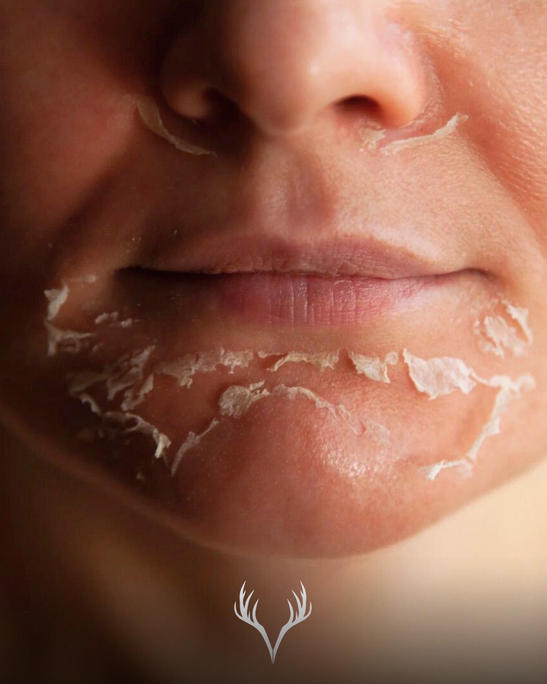 Peelings in Baden – von „du spürst nichts“ bis Schälkur ✨
Viele denken bei Peelings sofort an starke Schuppung und „nicht gesellschaftsfähig“. Aber die Wahrheit ist: Peeling ist nicht gleich Peeling – und genau deshalb lieben wir diese Kategorie so sehr. Wir können damit extrem gezielt arbeiten, je nach Hautzustand, Ziel und Jahreszeit.
Bei uns gibt es verschiedene Arten von Peelings:
• super sanfte Peelings, bei denen du praktisch gar nichts merkst
• Peelings mit leichter Trockenheit oder feinem Schüppchen
• intensivere Varianten bis hin zur Schälkur (für alle, die wirklich mehr Veränderung möchten)
Was für dich richtig ist, klären wir nicht nach Bauchgefühl – sondern mit unserer Observ Hautanalyse 🔬
Dabei schauen wir genau hin: Welche Hautschichten brauchen Unterstützung? Was ist dein Ziel (Unreinheiten, Poren, Pigment, Anti-Aging, Textur)? Und was lässt die aktuelle Jahreszeit sinnvoll zu?
So bekommst du bei uns immer:
✅ ehrliche Beratung
✅ realistische Erwartungen (inkl. möglicher Ausfallszeit)
✅ den schnellsten und gleichzeitig hautgesunden Weg zu deinem Hautziel
Wenn du Peelings bisher gemieden hast, weil du Angst vor zu viel Reaktion hattest: Genau dafür gibt’s Personalisierung. Und genau dafür bist du bei uns in besten Händen. 🤍
📍 Beauty Bar Baden – Peelings & Hautveränderung
📞 Termine telefonisch oder über unser Online-Buchungstool
#peelingbaden #chemischespeeling #schälkur #hauterneuerung #hautveränderung #observhautalyse #observskinanalysis #kosmetikbaden #beautybarbaden #badenbeiwien #poren #hyperpigmentierung #aknebehandlung #hauttextur #skintransformation